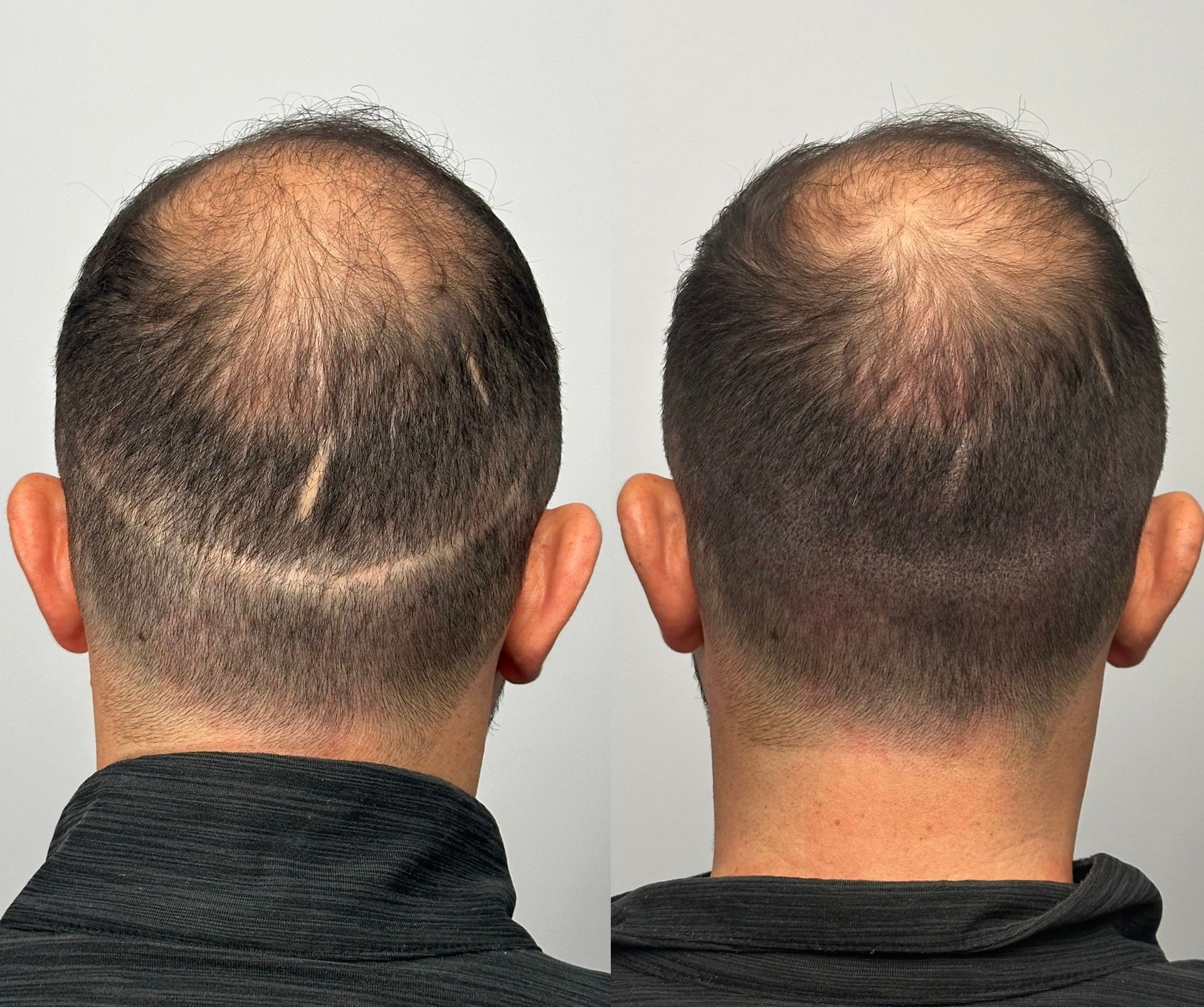 Two views of a man's shaved head, showing hair loss and a scar on the back of his scalp.