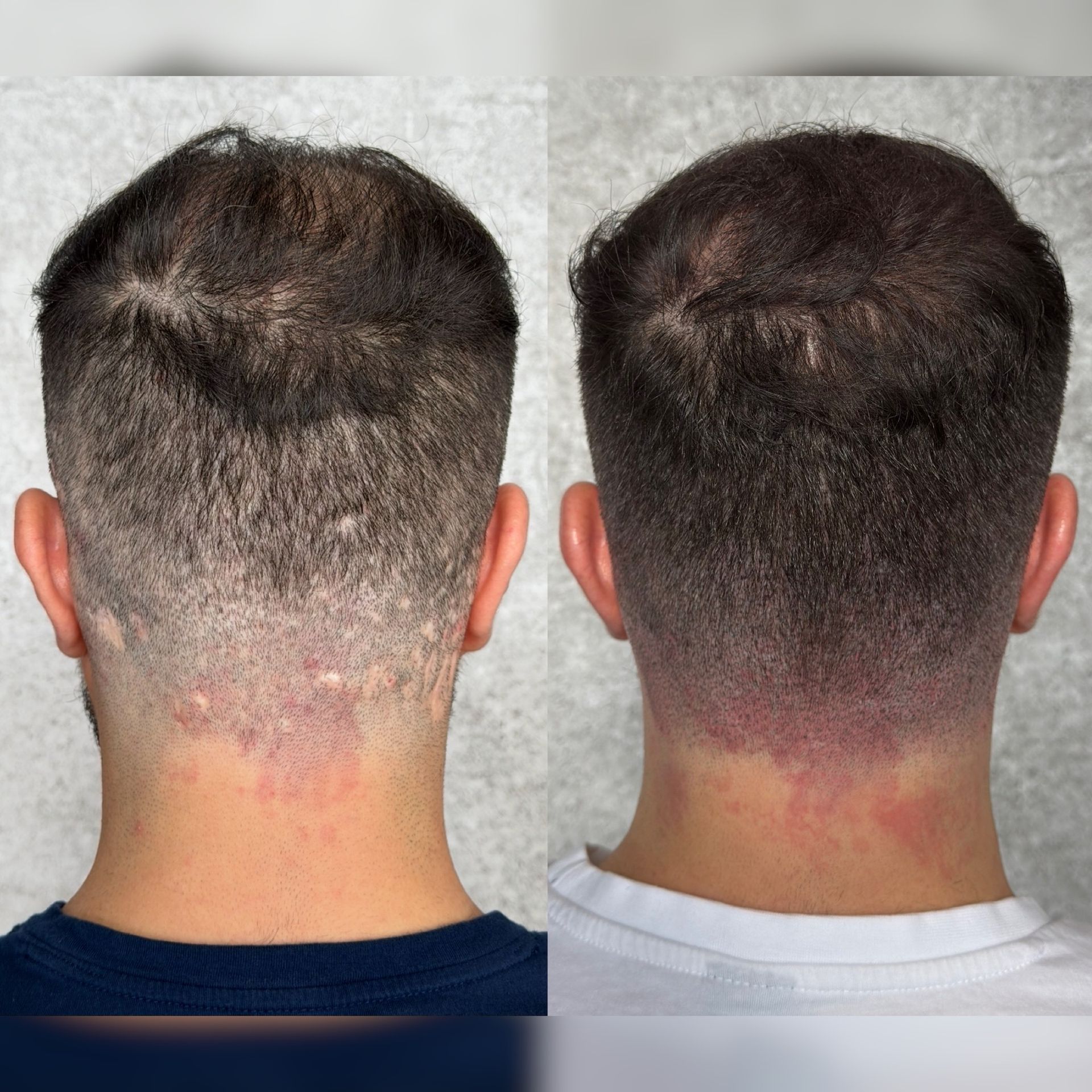 Comparison of two views of a person's head: before (left) and after (right) hair restoration treatment.