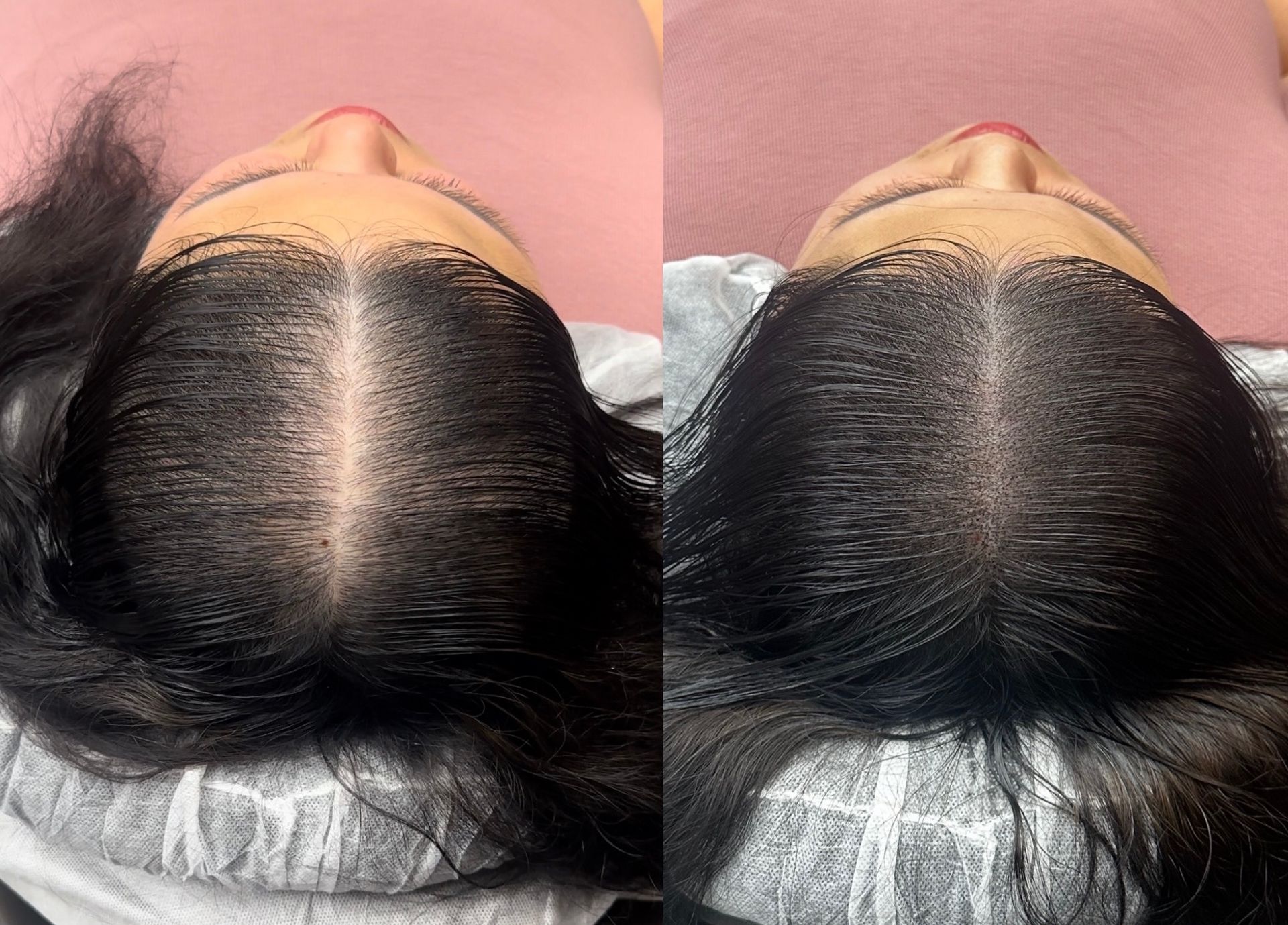 Two overhead views of a person's scalp. The left has thinner hair, right image has more coverage.