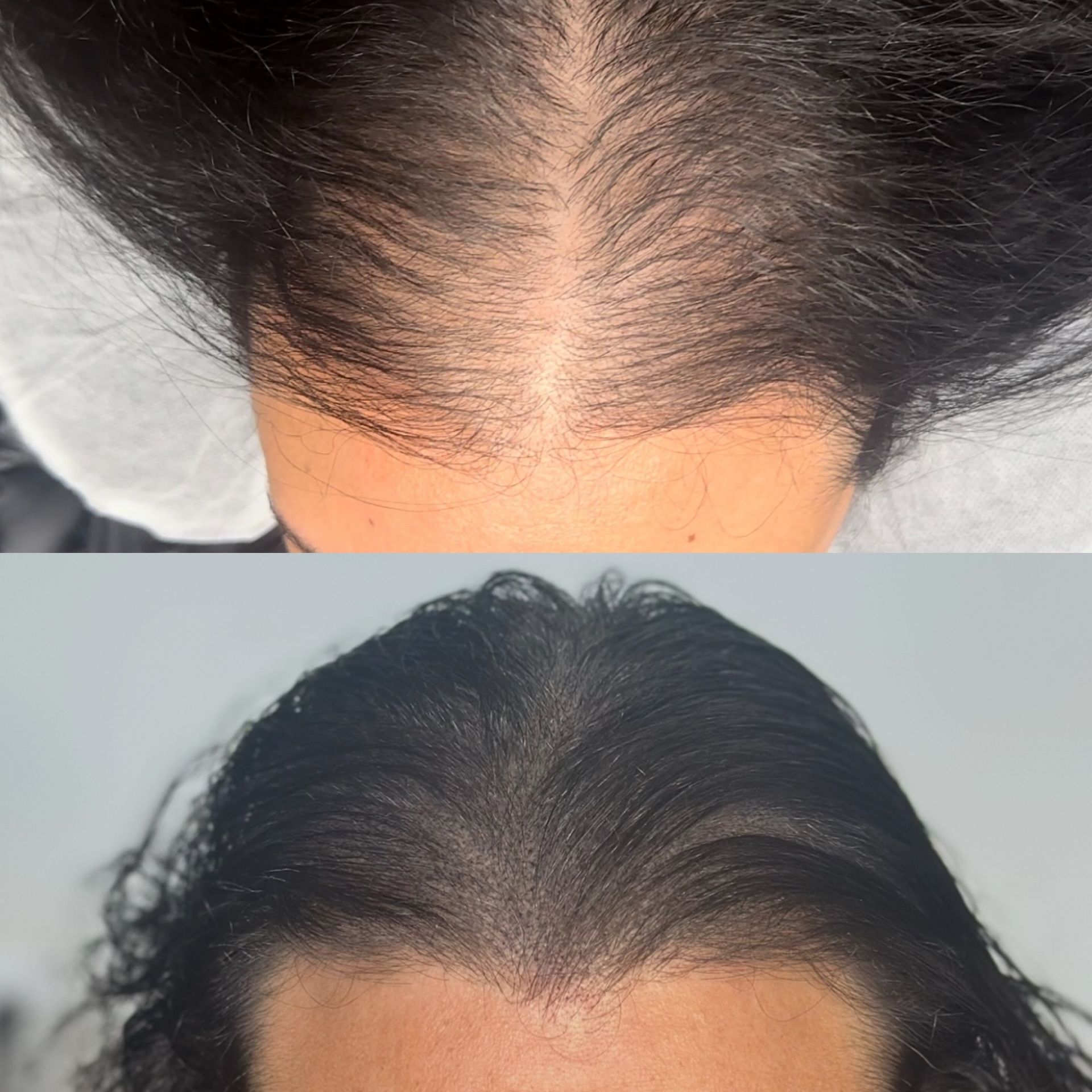 Before-and-after of a person's hairline; top shows thinning, bottom shows fuller hair after a treatment.