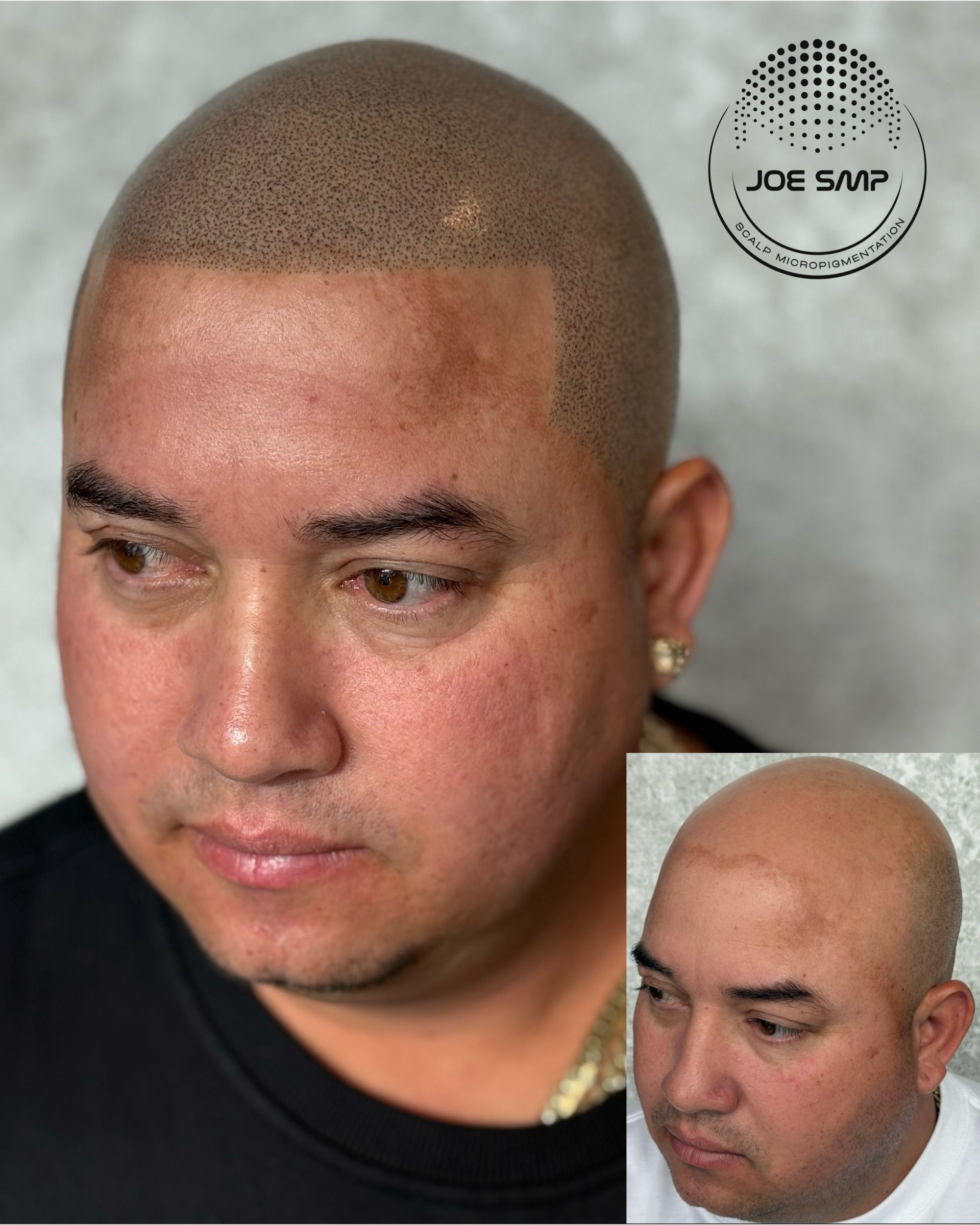 Man with scalp micropigmentation, showcasing before-and-after, brown dots simulating hair, near-bald head, in studio setting.