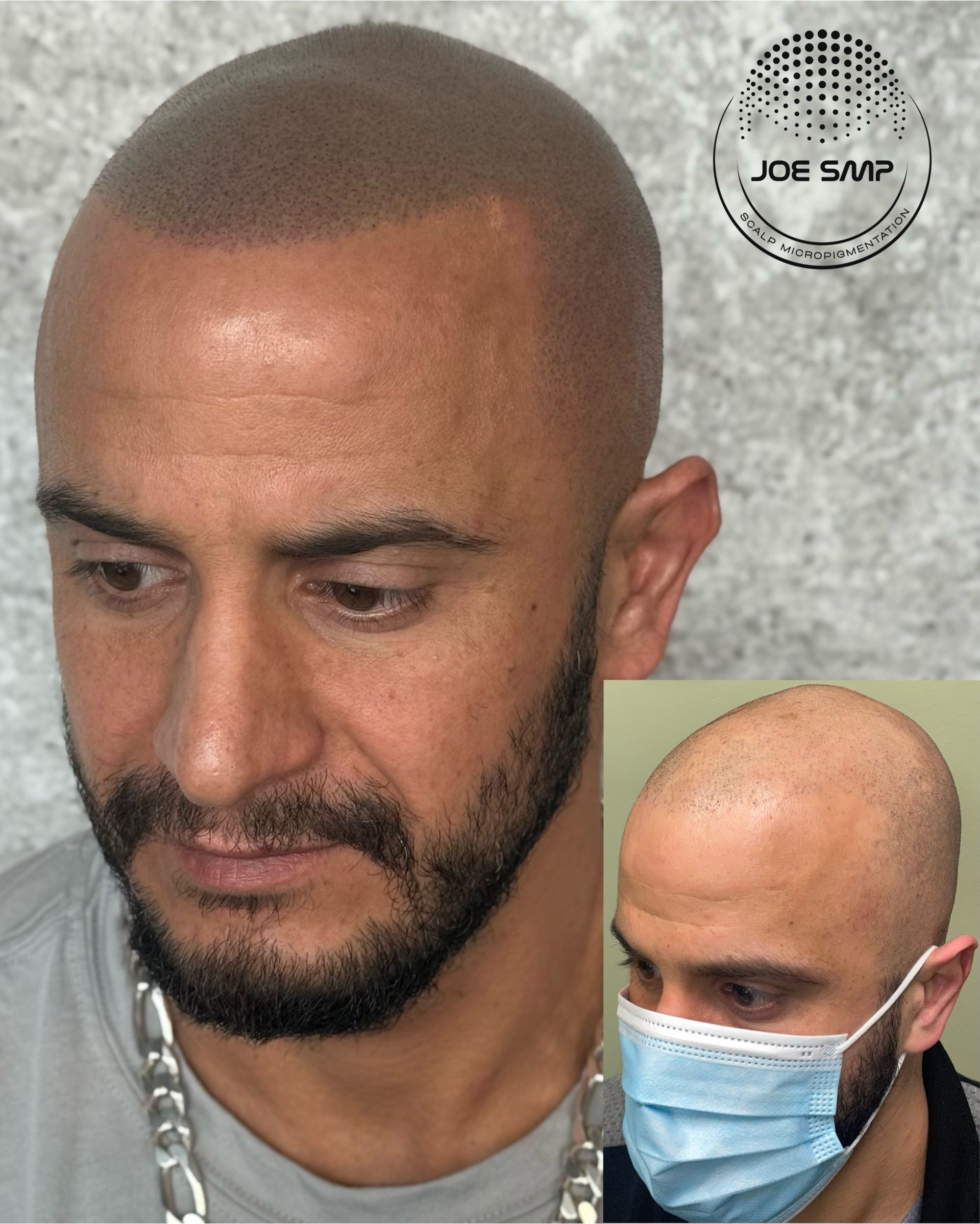 Man with scalp micropigmentation; inset shows pre-procedure. He has a beard and is wearing a gray shirt.