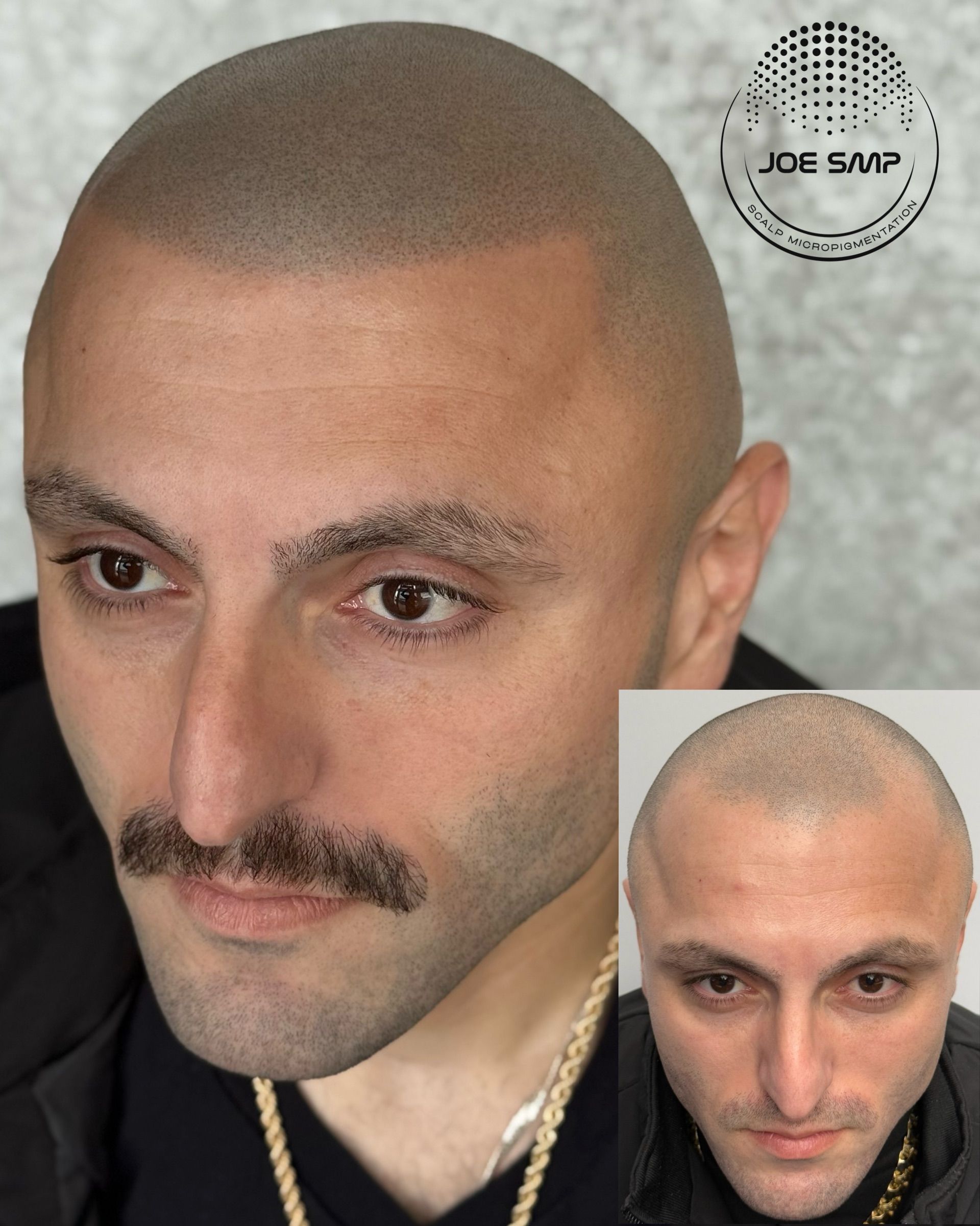 Man with scalp micropigmentation, mustache, and inset photo of his scalp before treatment.