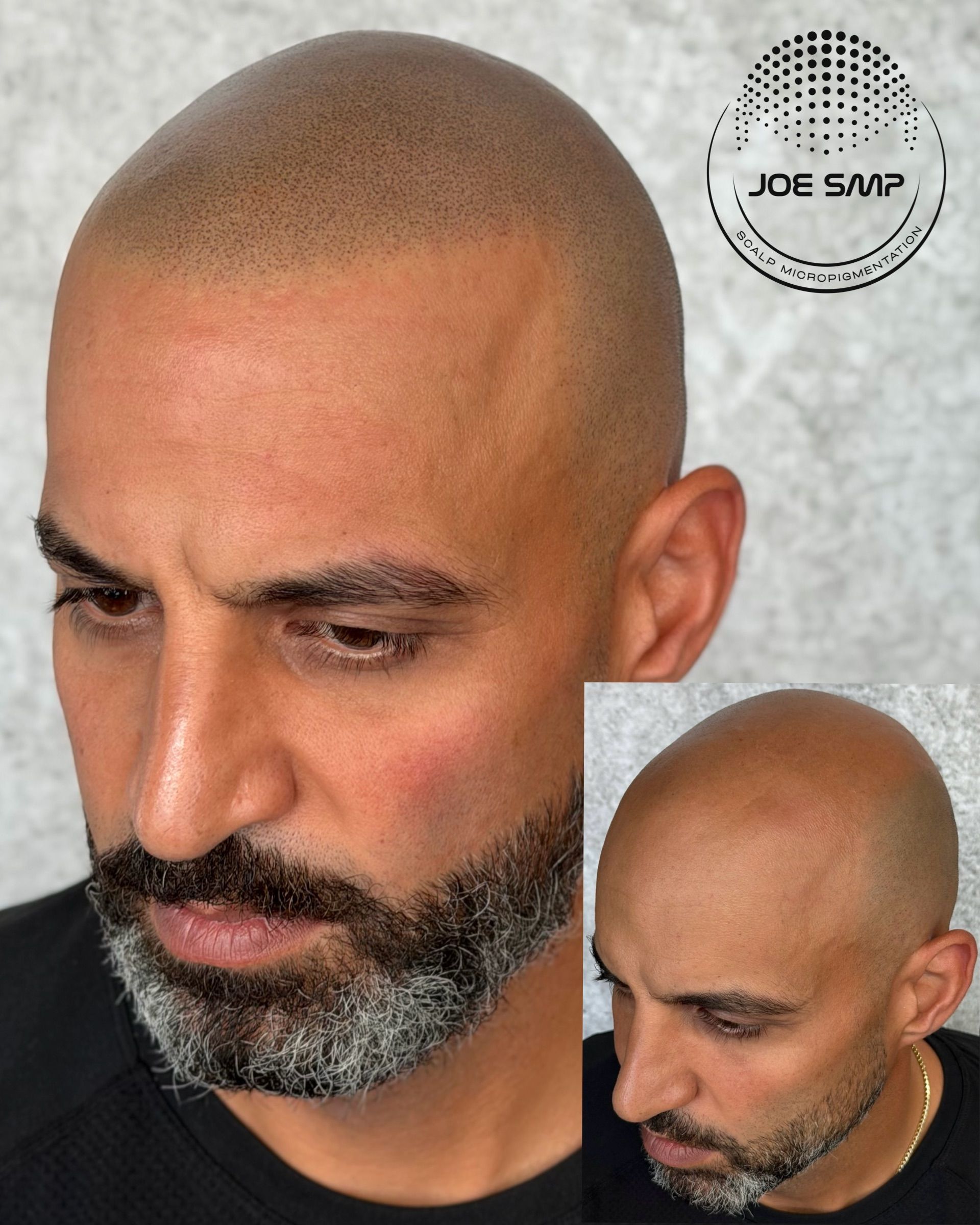Man with shaved head and scalp micropigmentation, showcasing a hair loss solution.