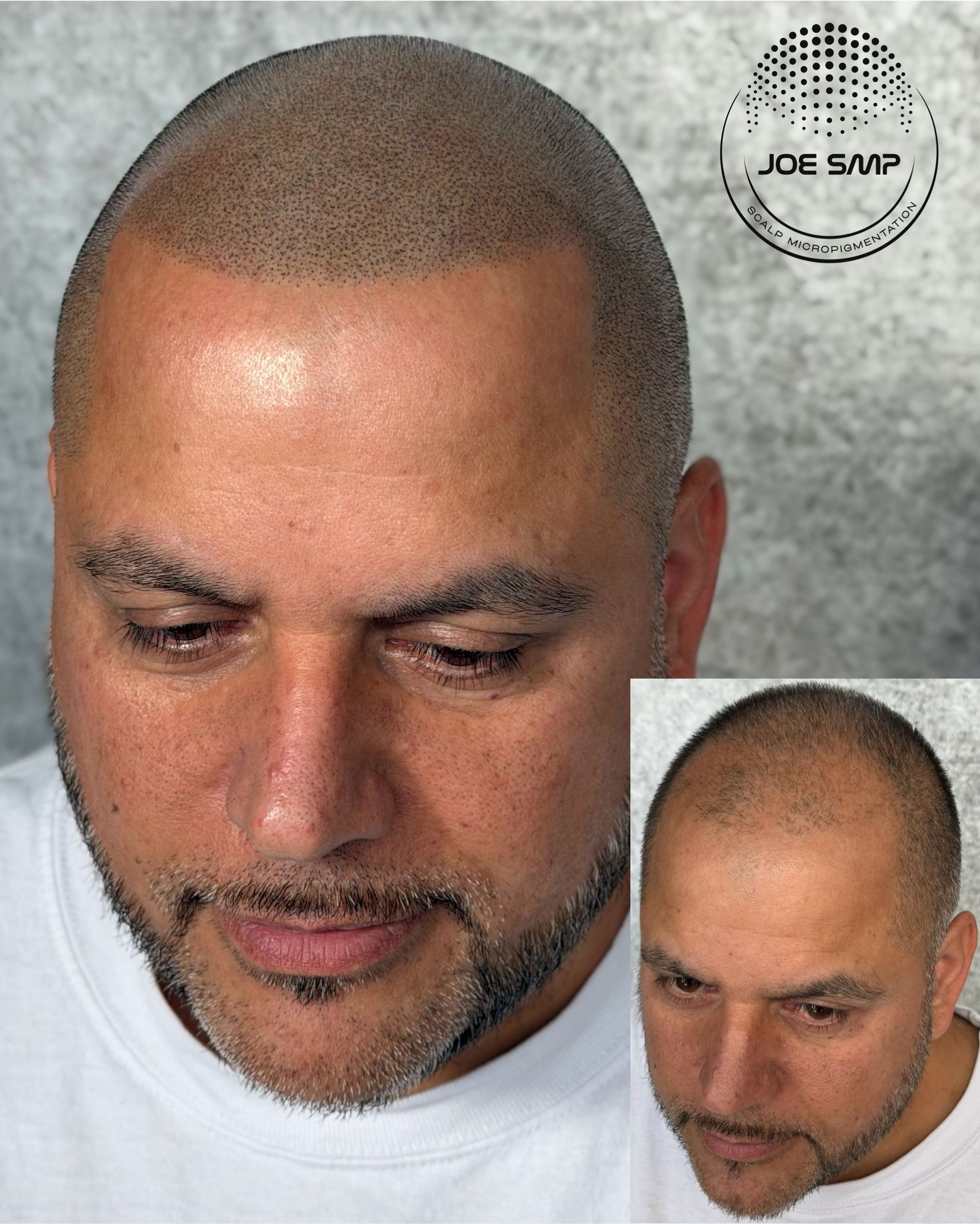 Man with shaved head, showing scalp micropigmentation. Main image and small inset view. Dark hair dots on the scalp.