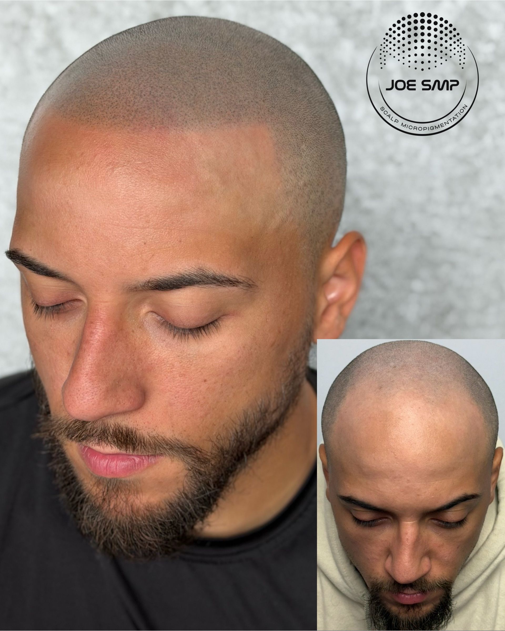 Man with scalp micropigmentation, showcasing a before-and-after comparison.