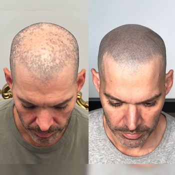 Scalp micropigmentation: Before and after view of a man's head, with hair loss resolved by tattooing tiny dots.