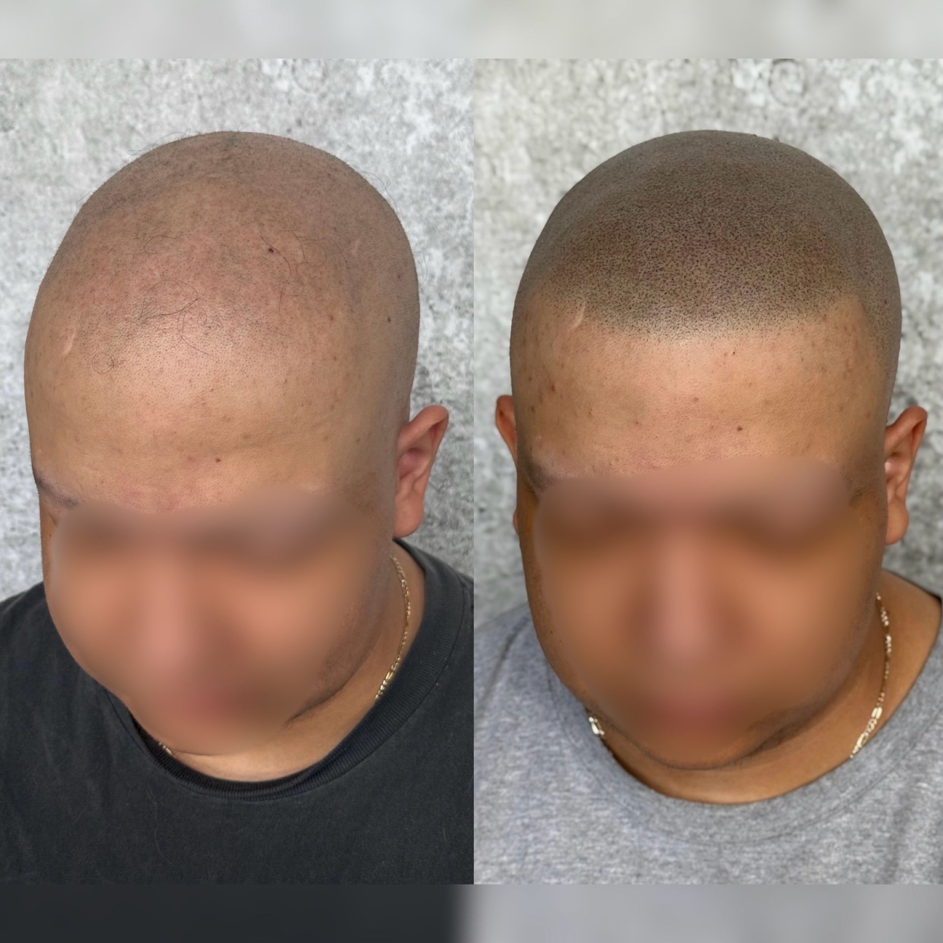 Scalp Micropigmentation: Bald head before (left) and after (right) treatment, simulating the look of a shaved head.