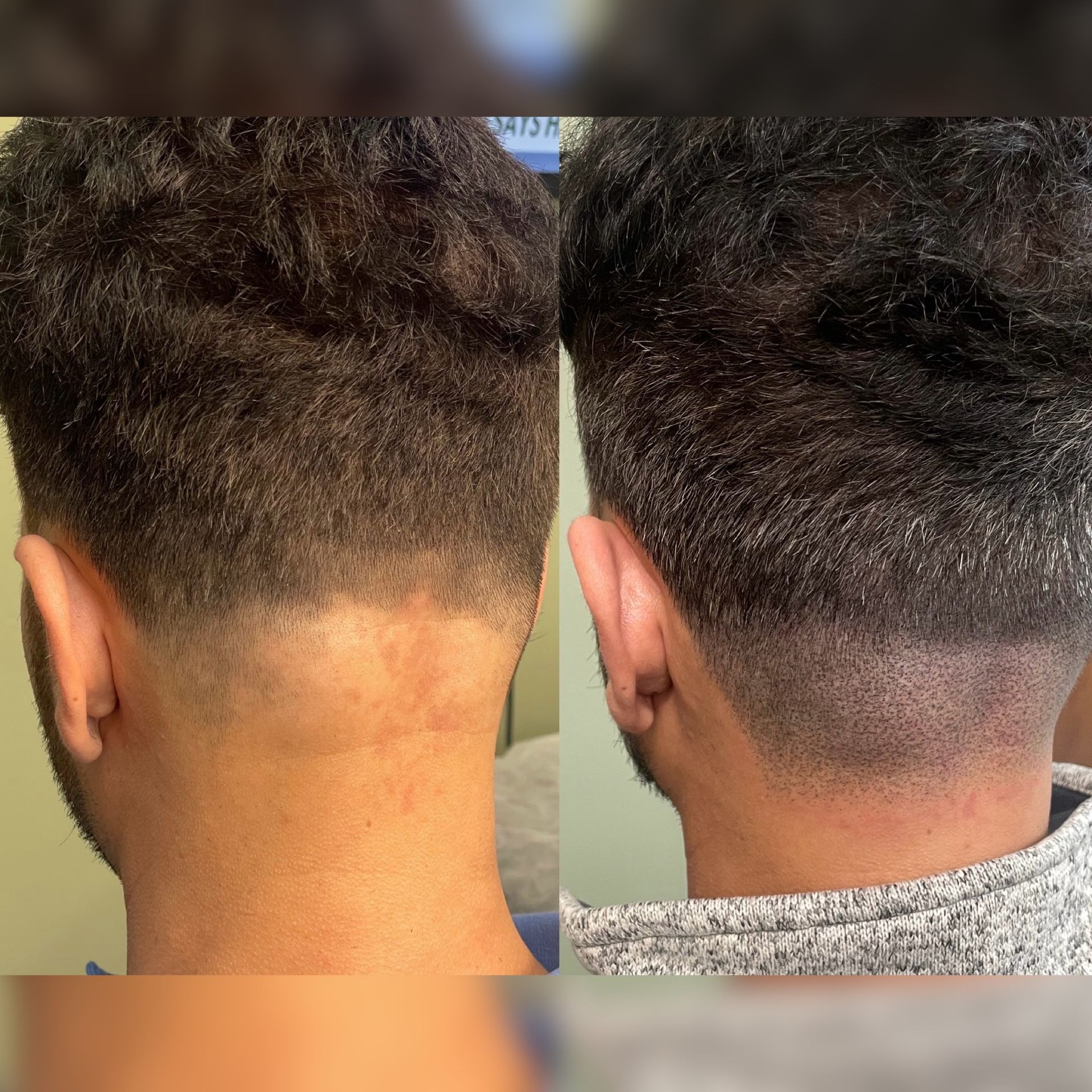 Two views of a person's neck. Before (left) and after (right) a haircut, showing a cleaner neckline.