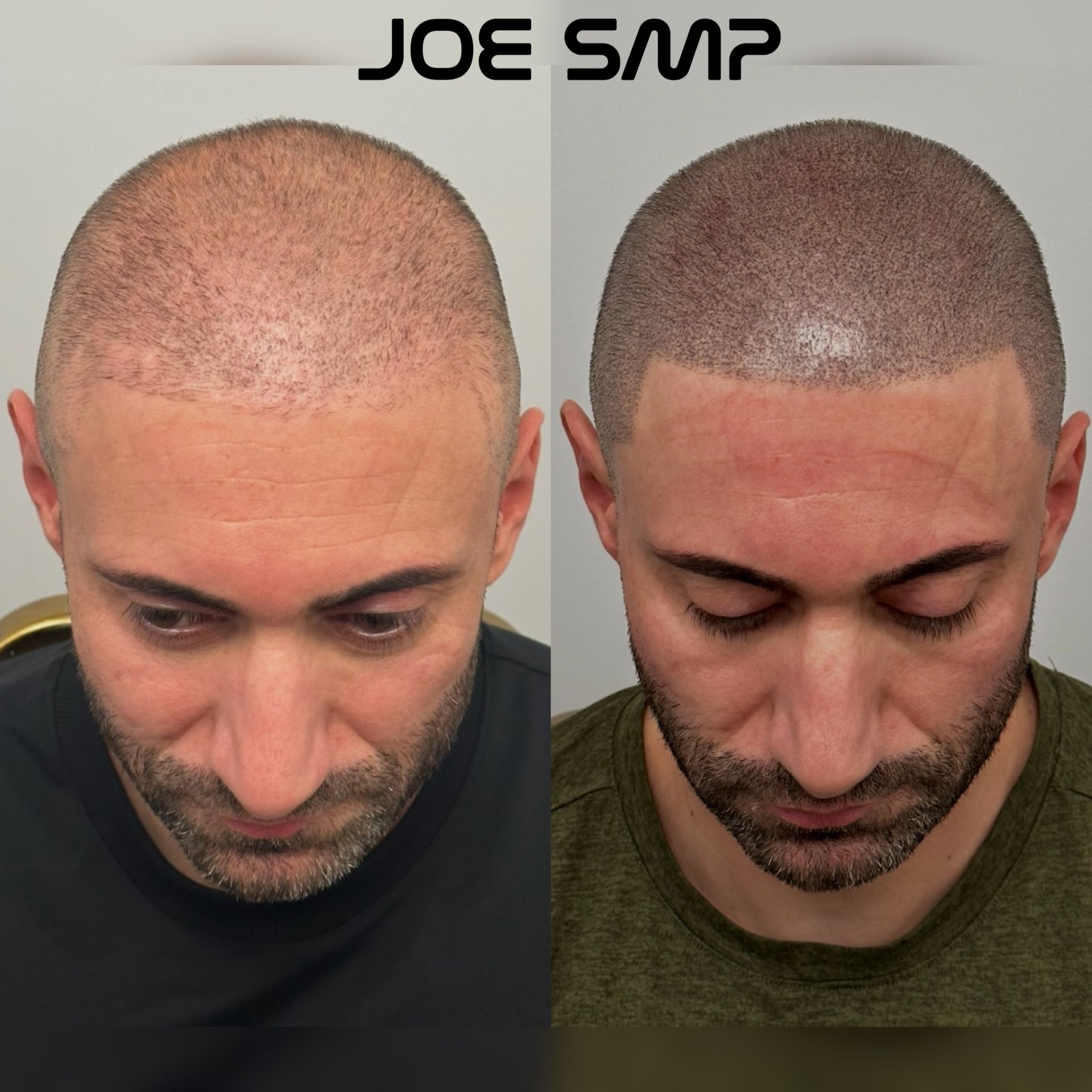 Before and after photos showing scalp micropigmentation on a man, simulating a shaved head look.