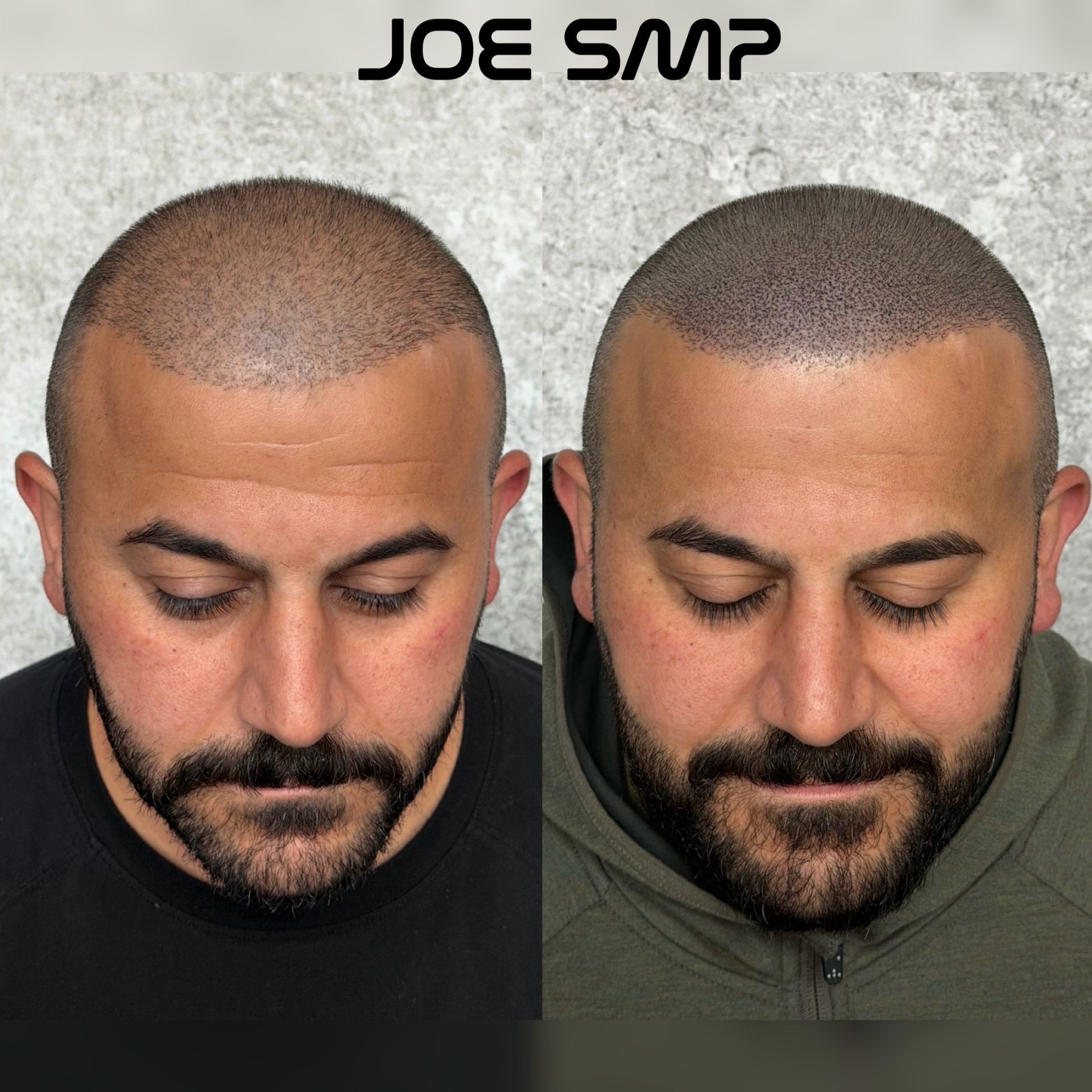 Before-and-after of a man with scalp micropigmentation, showcasing a fuller hairline.