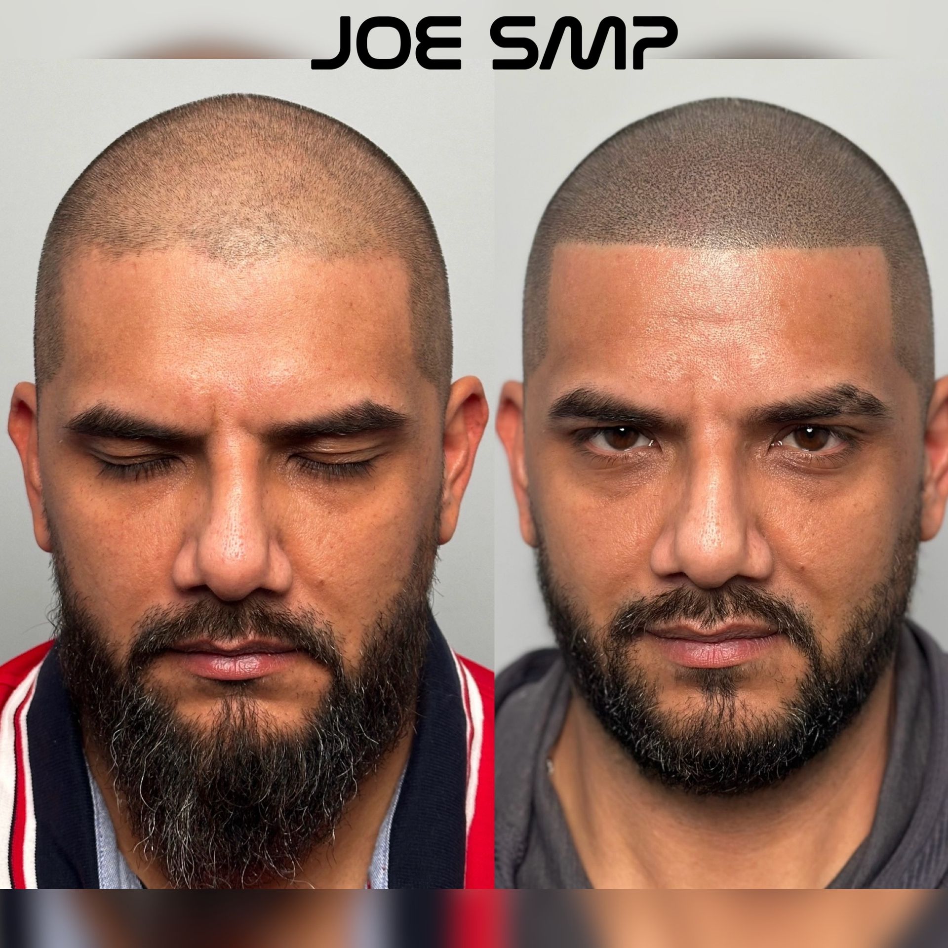 Side-by-side comparison of a man before and after scalp micropigmentation. Dark brown scalp, matching beard.