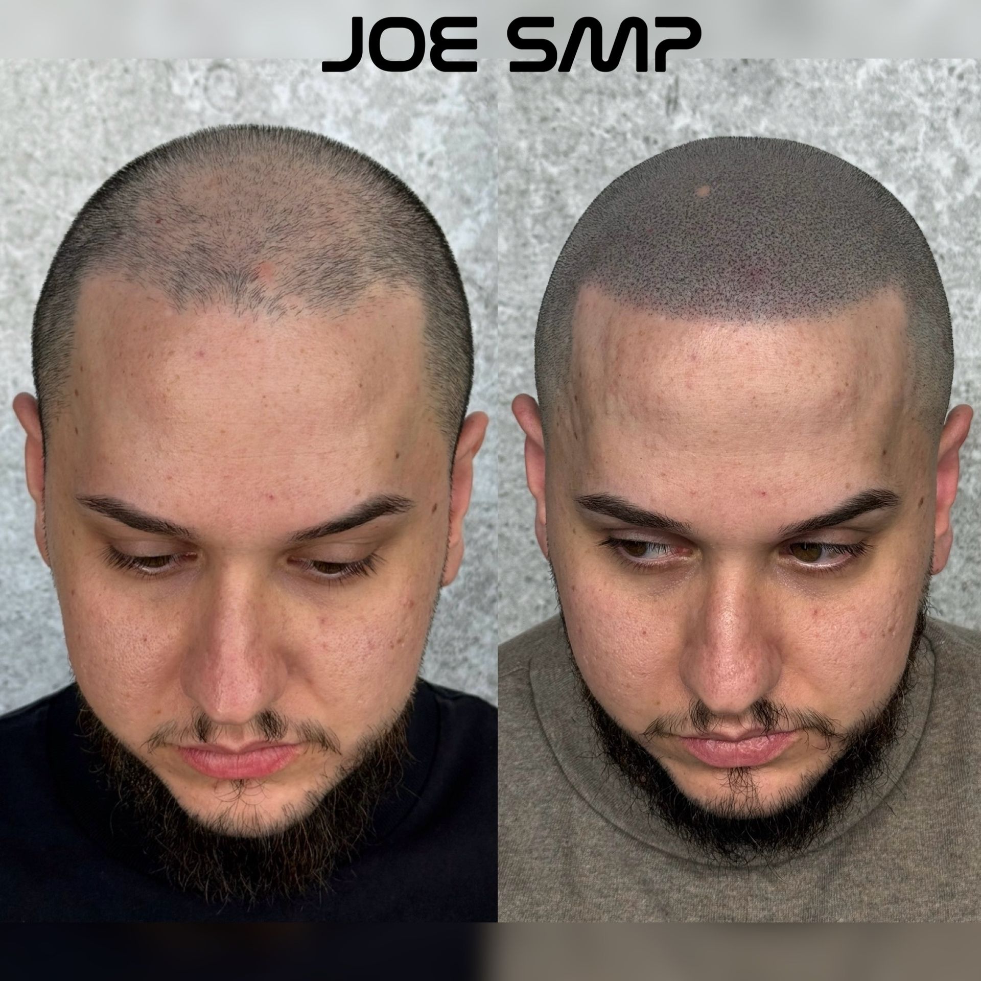 Scalp micropigmentation before and after. Bald man with hairline now filled with tiny dots; dark stubble beard.