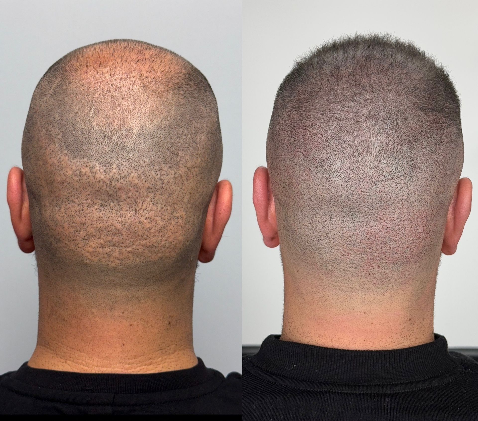 Scalp micropigmentation before and after. Bald head with sparse hair on the left, fully covered on the right.
