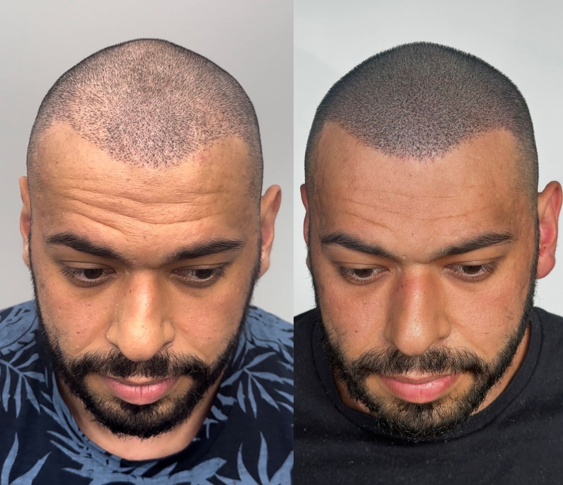 Before and after comparison of a scalp micropigmentation treatment on a man's head.