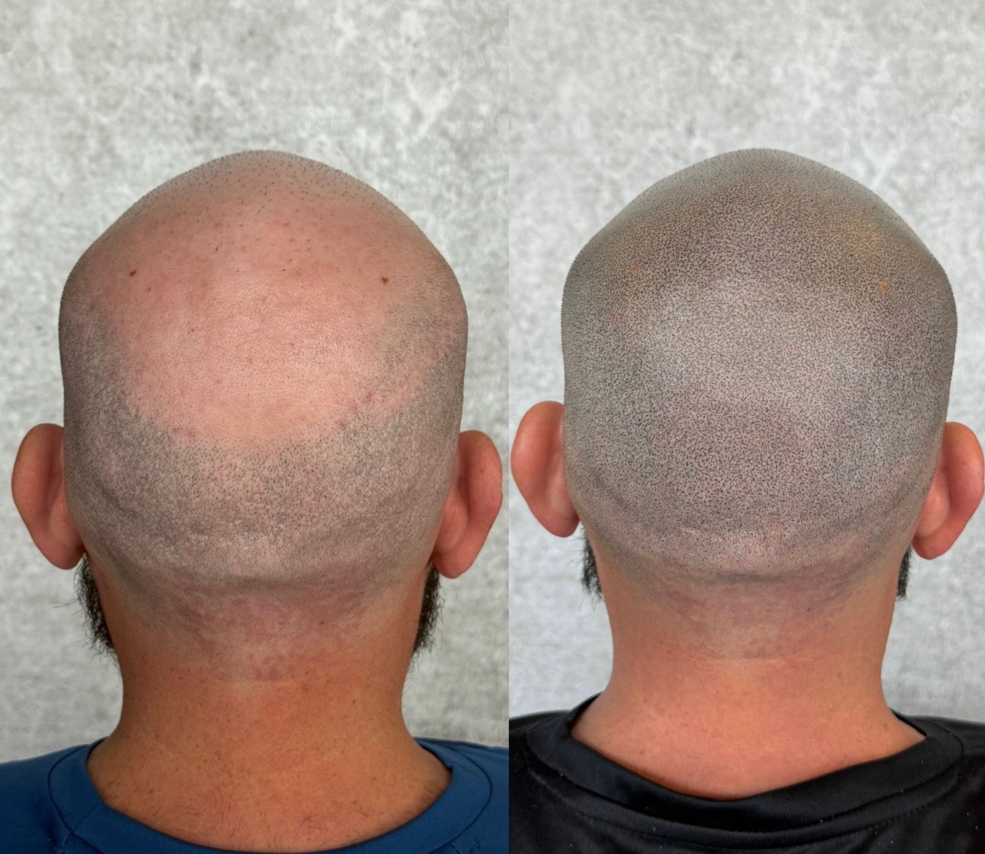 Before and after of a shaved head; scalp micropigmentation creates a simulated hair follicle appearance.