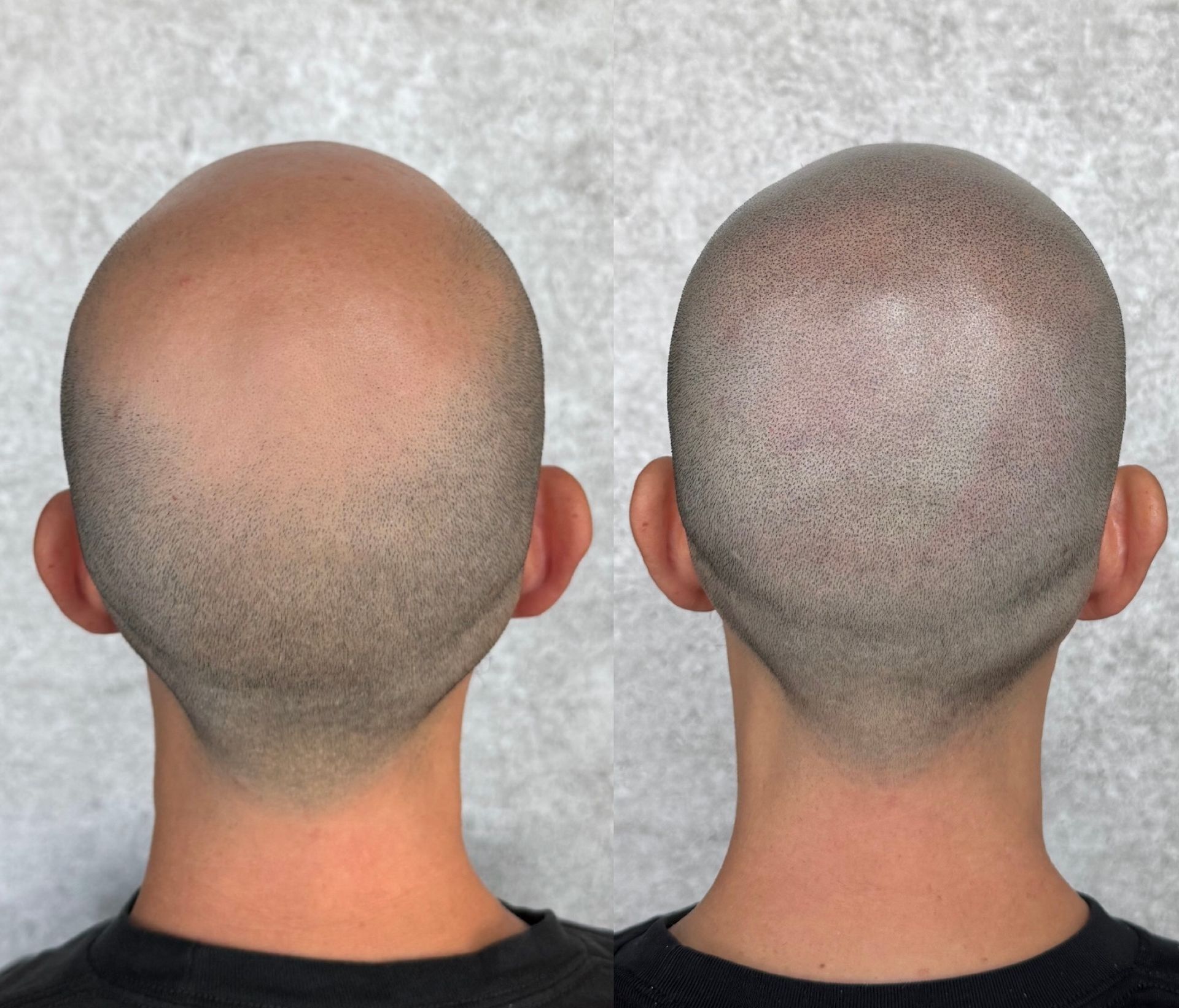 Comparison of a bald head before and after scalp micropigmentation, showing simulated hair follicles.