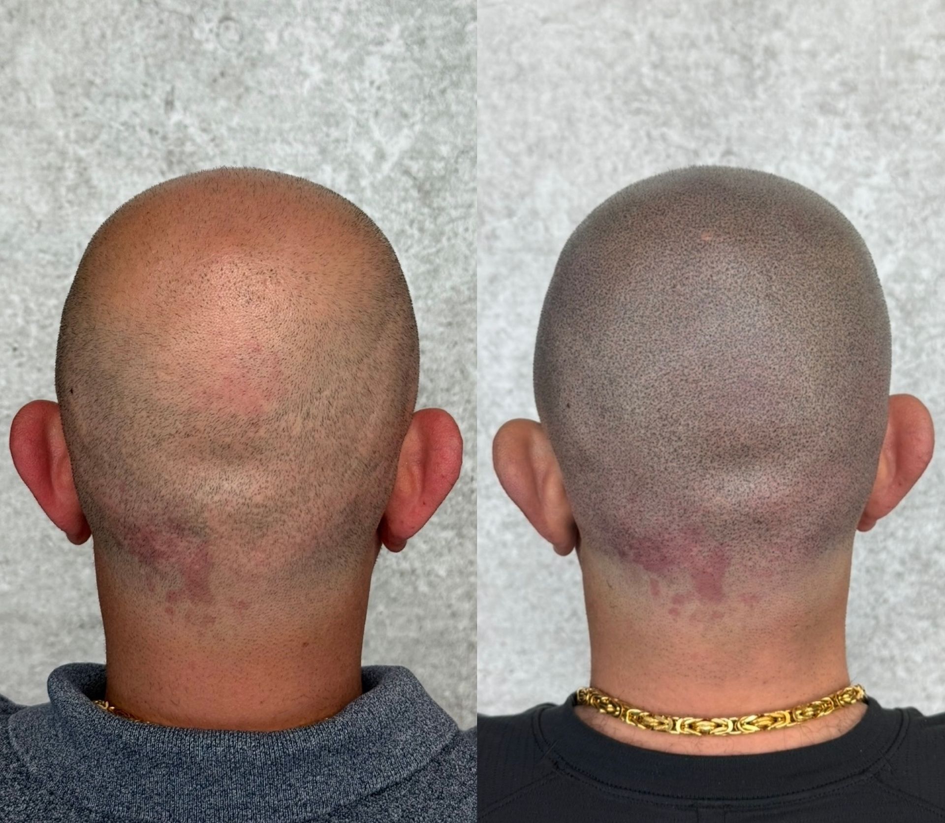 Before and after of a shaved head. The right side shows scalp micropigmentation, creating the illusion of hair follicles.
