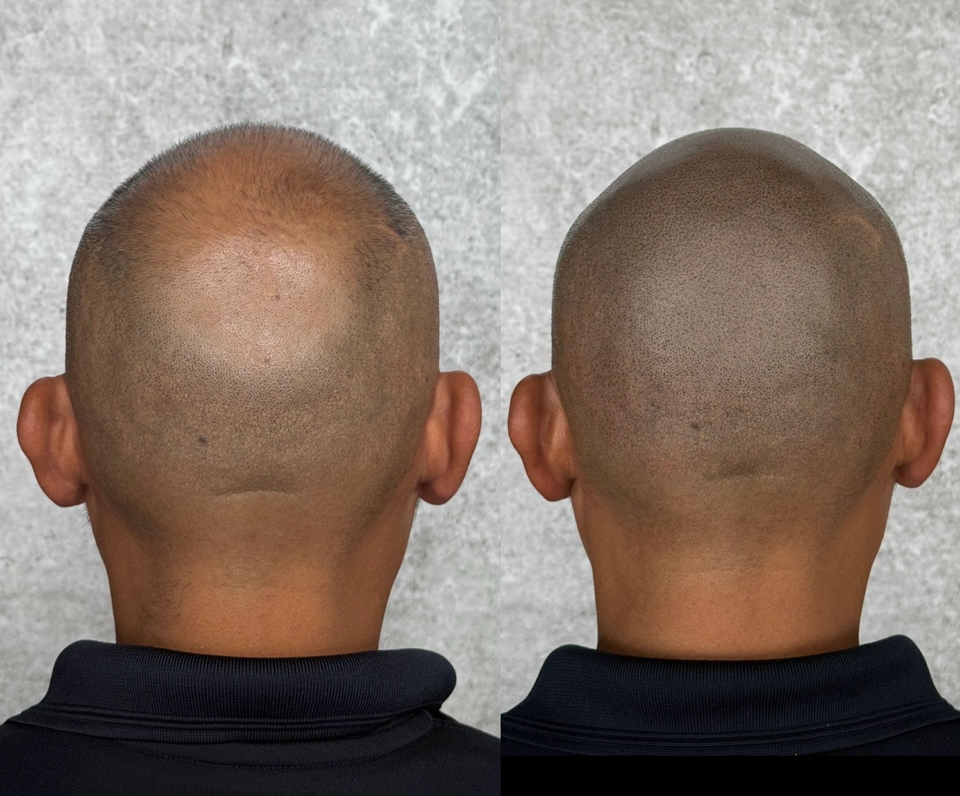 Two views of a shaved head; left shows thinning hair, right shows scalp micropigmentation creating a full appearance.