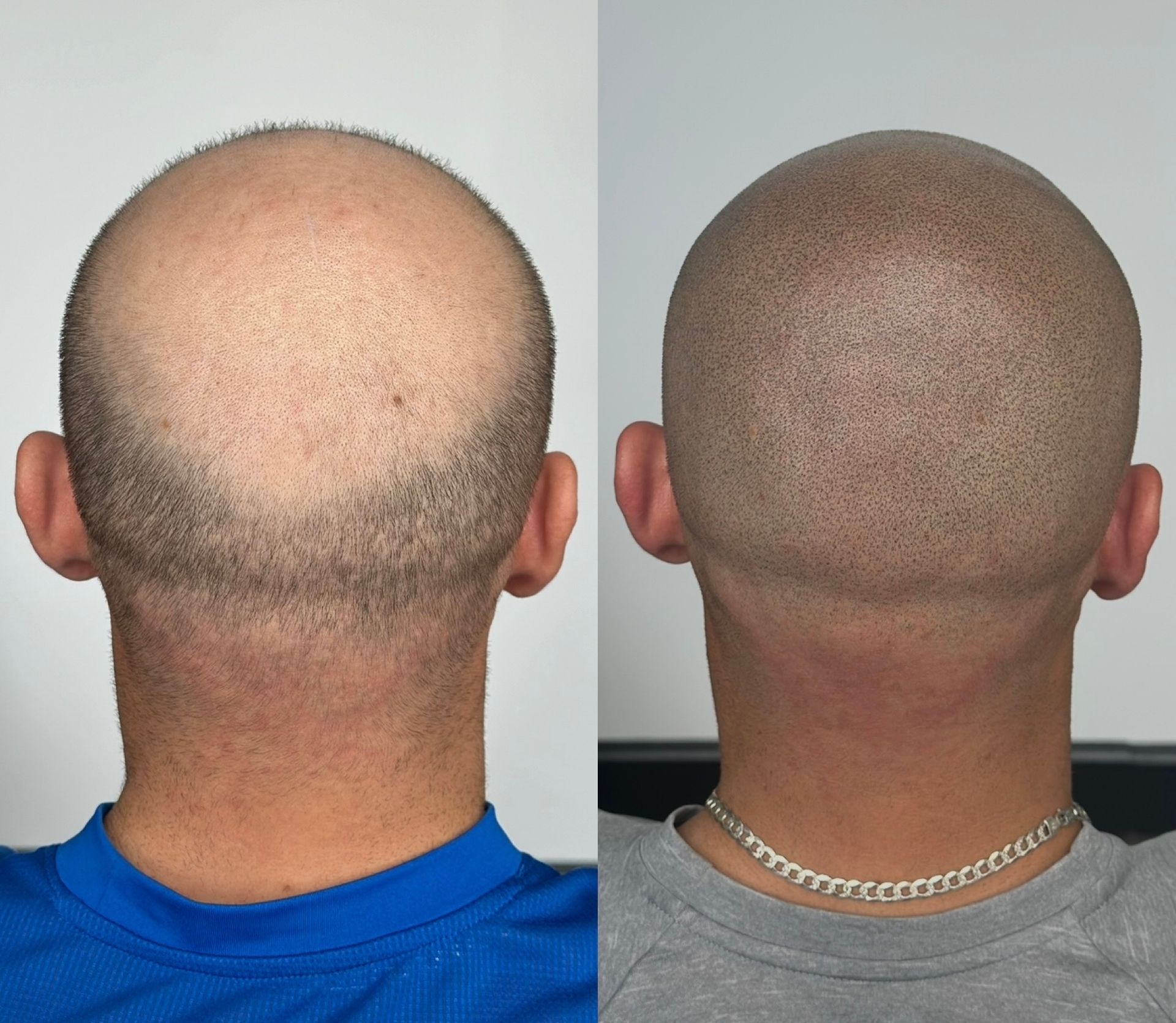 Before and after views of a shaved head; receding hairline visible before, scalp micropigmentation visible after.