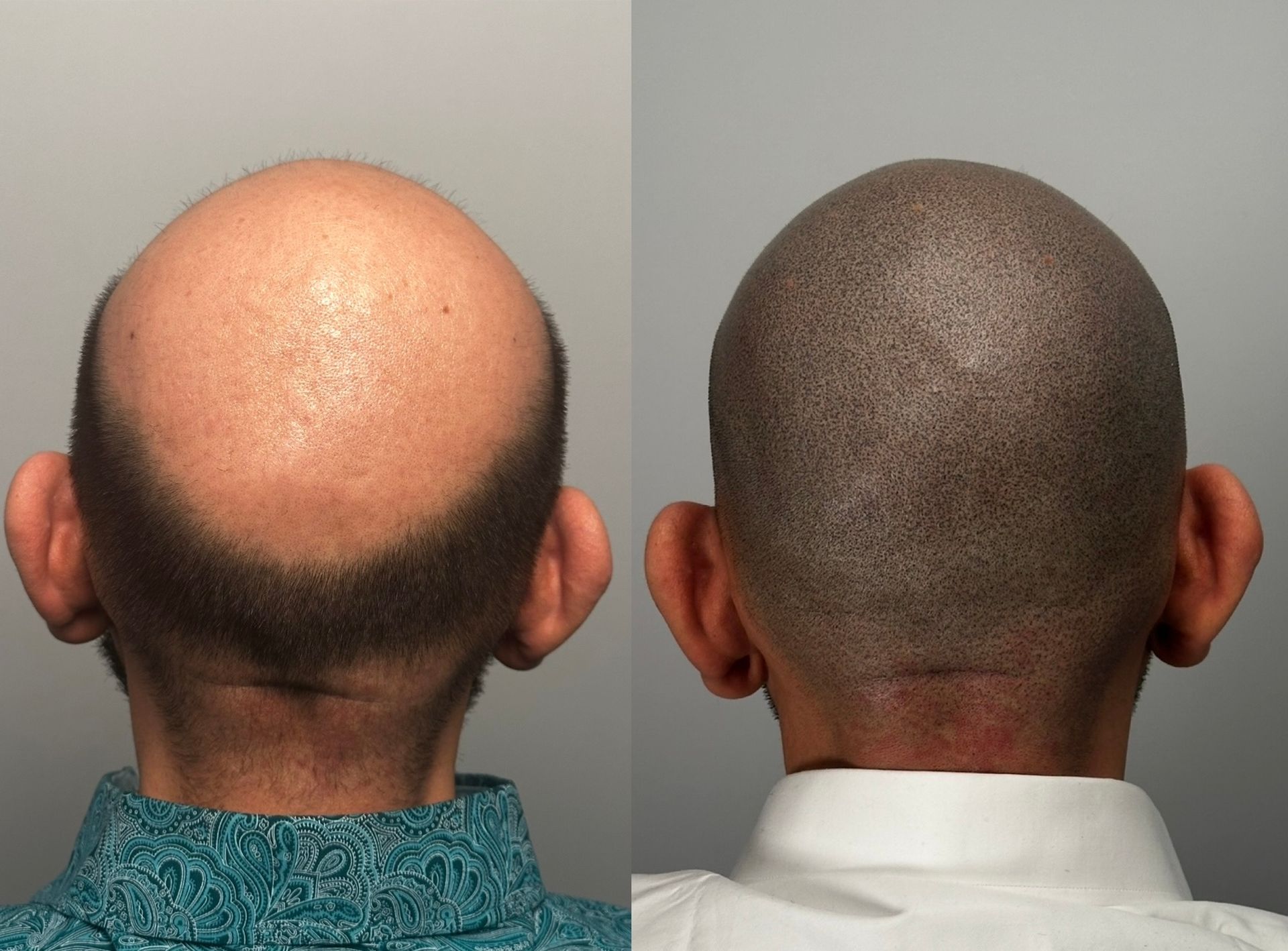 Before and after scalp micropigmentation: bald head with hair loss, then with shaved hair appearing fuller.