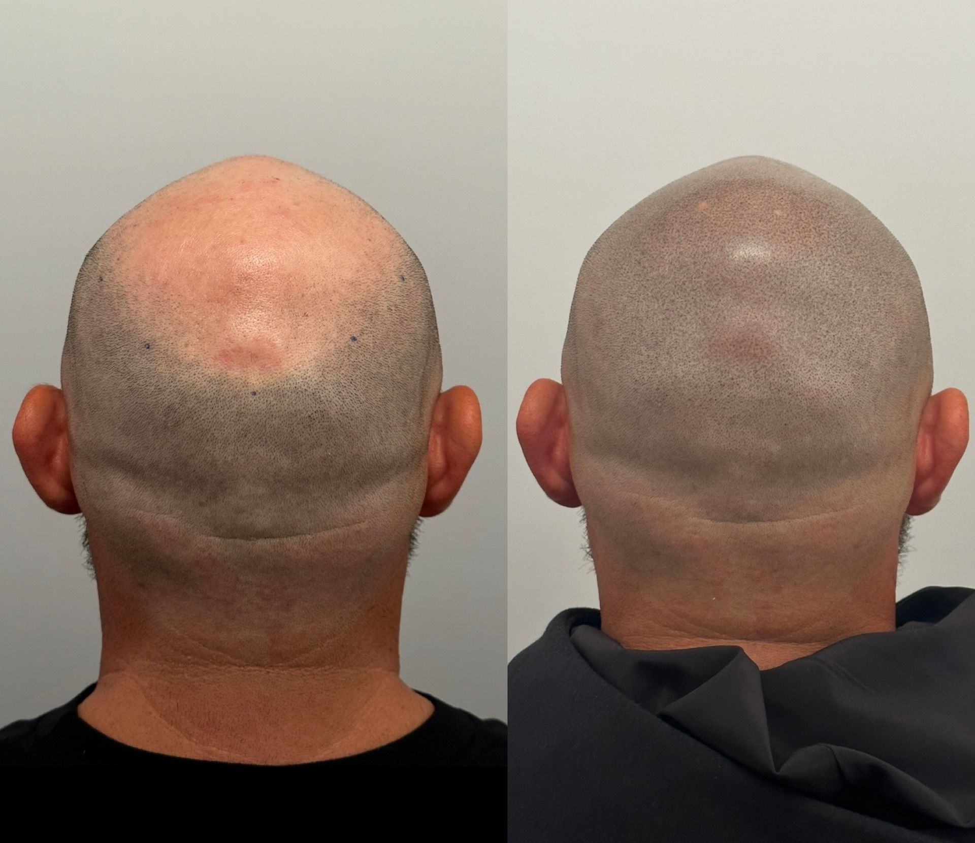 Comparison: Bald head before and after scalp micropigmentation.