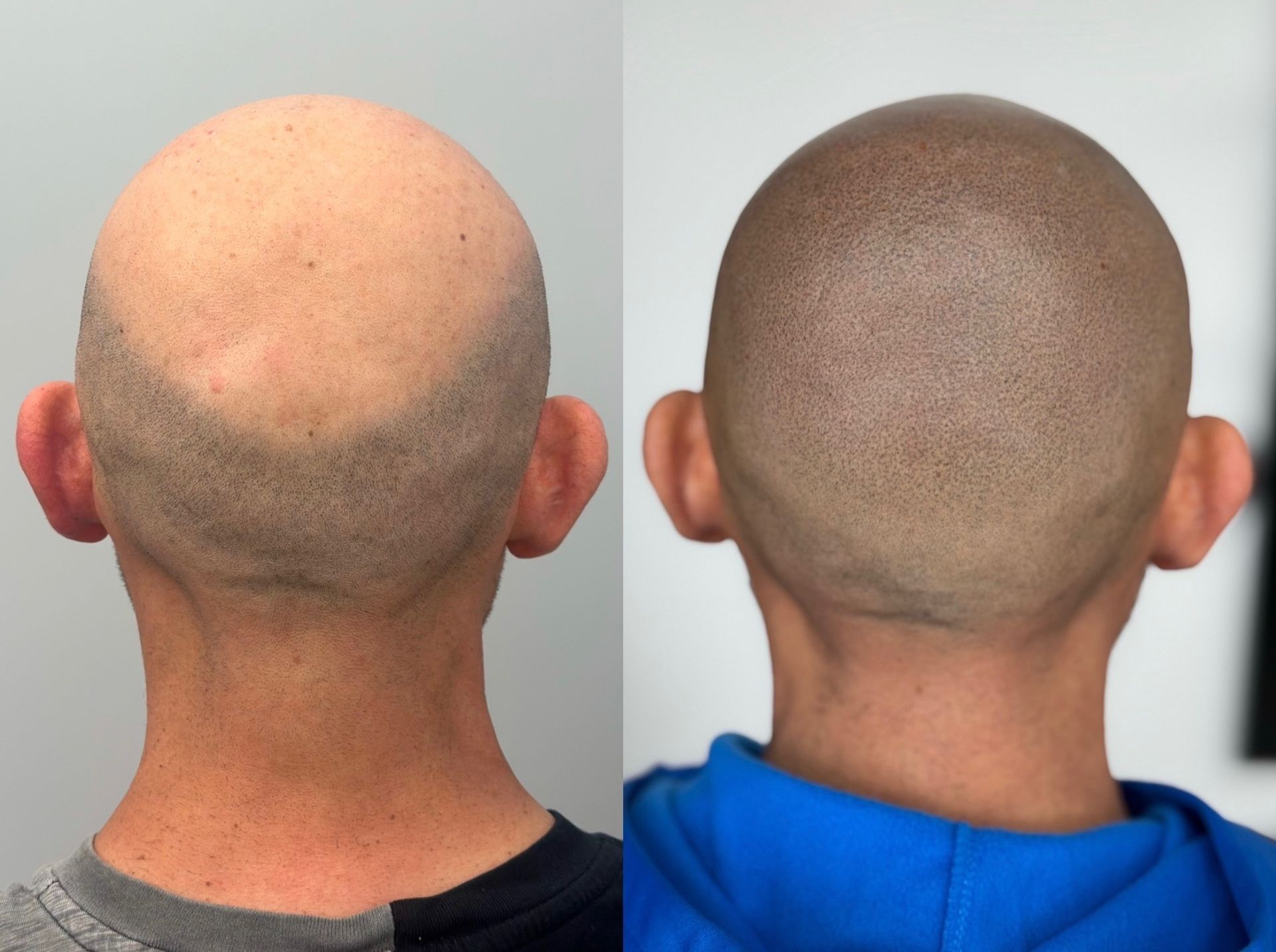 Before and after of a shaved head; left side shows hair loss, right side shows a scalp micropigmentation treatment.
