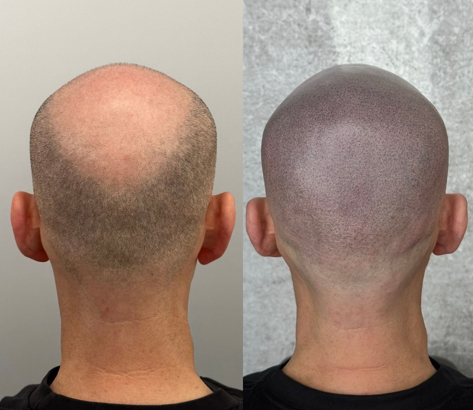Before and after scalp micropigmentation on a bald head; the right side shows the treated scalp with tiny dots.