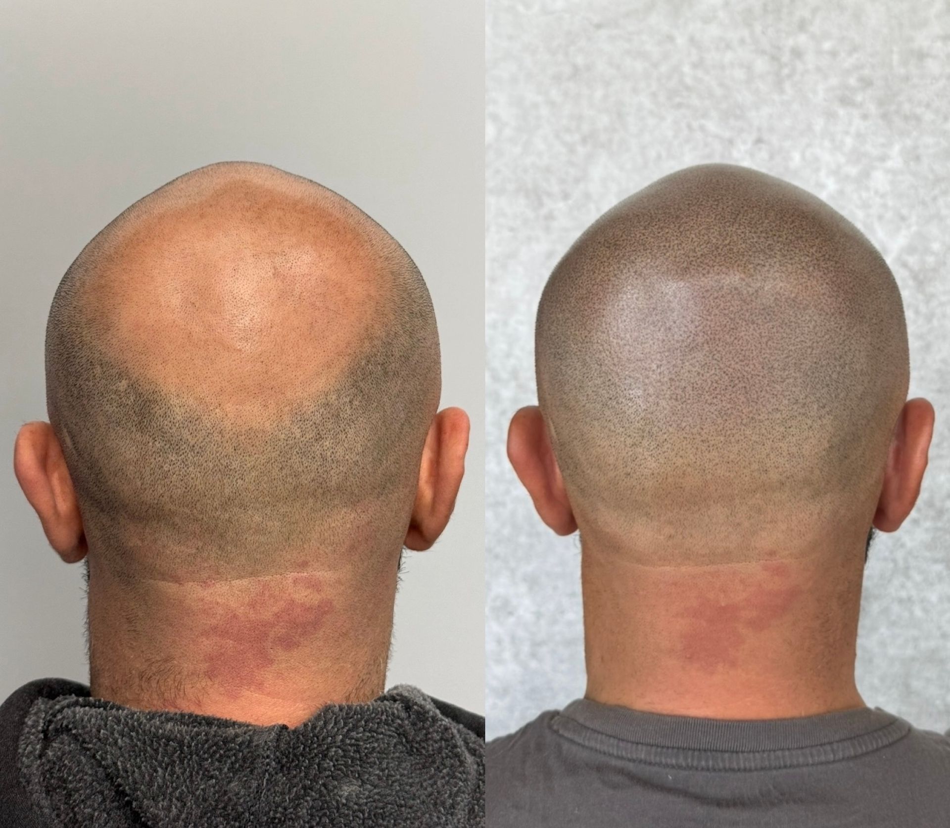 Scalp micropigmentation before and after: bald head with hair loss, then with shaved, dotted hair effect.