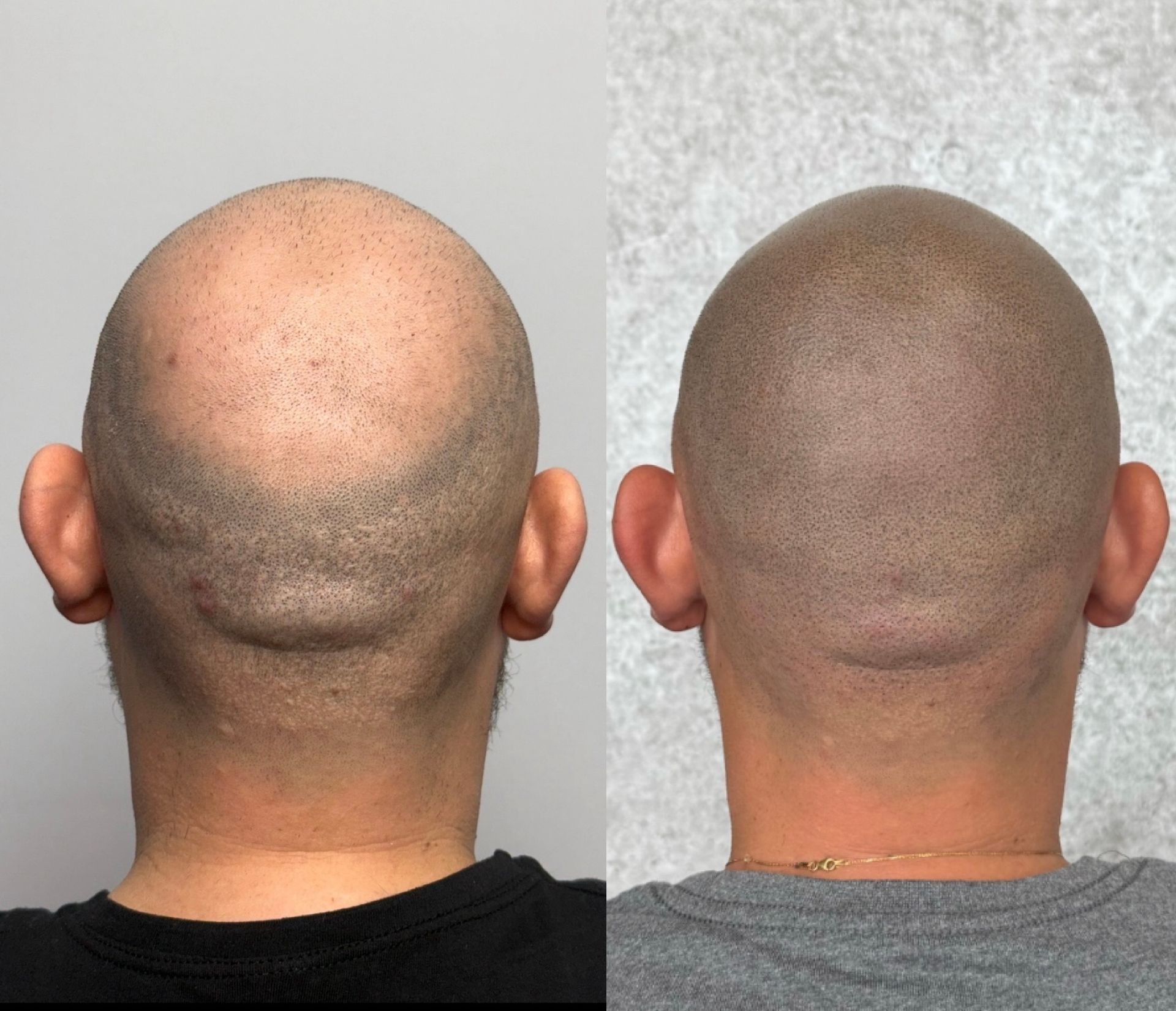 Scalp micropigmentation before and after. Bald head shows denser appearance after treatment.