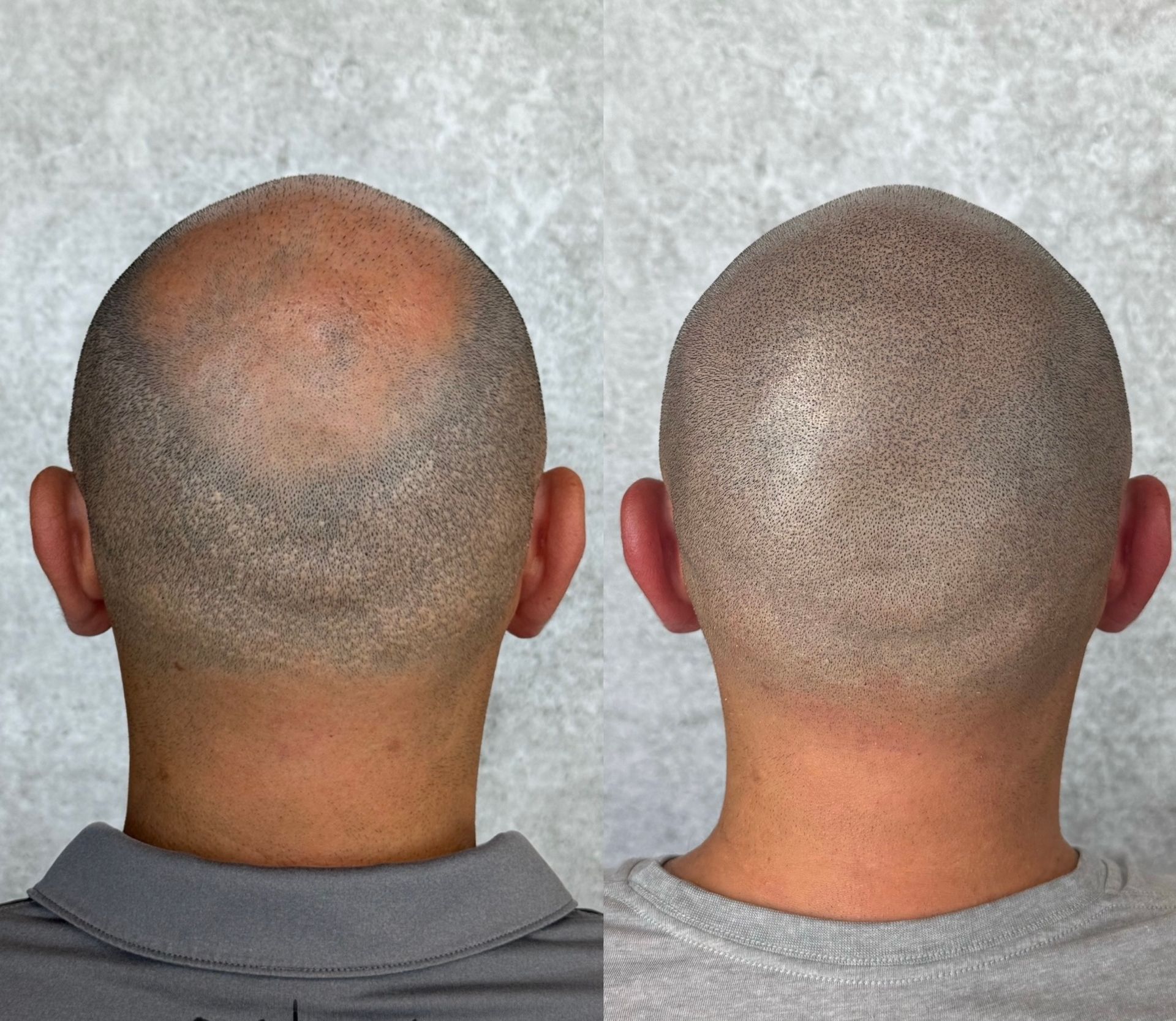 Before and after views of a shaved head with hair loss, followed by scalp micropigmentation treatment.
