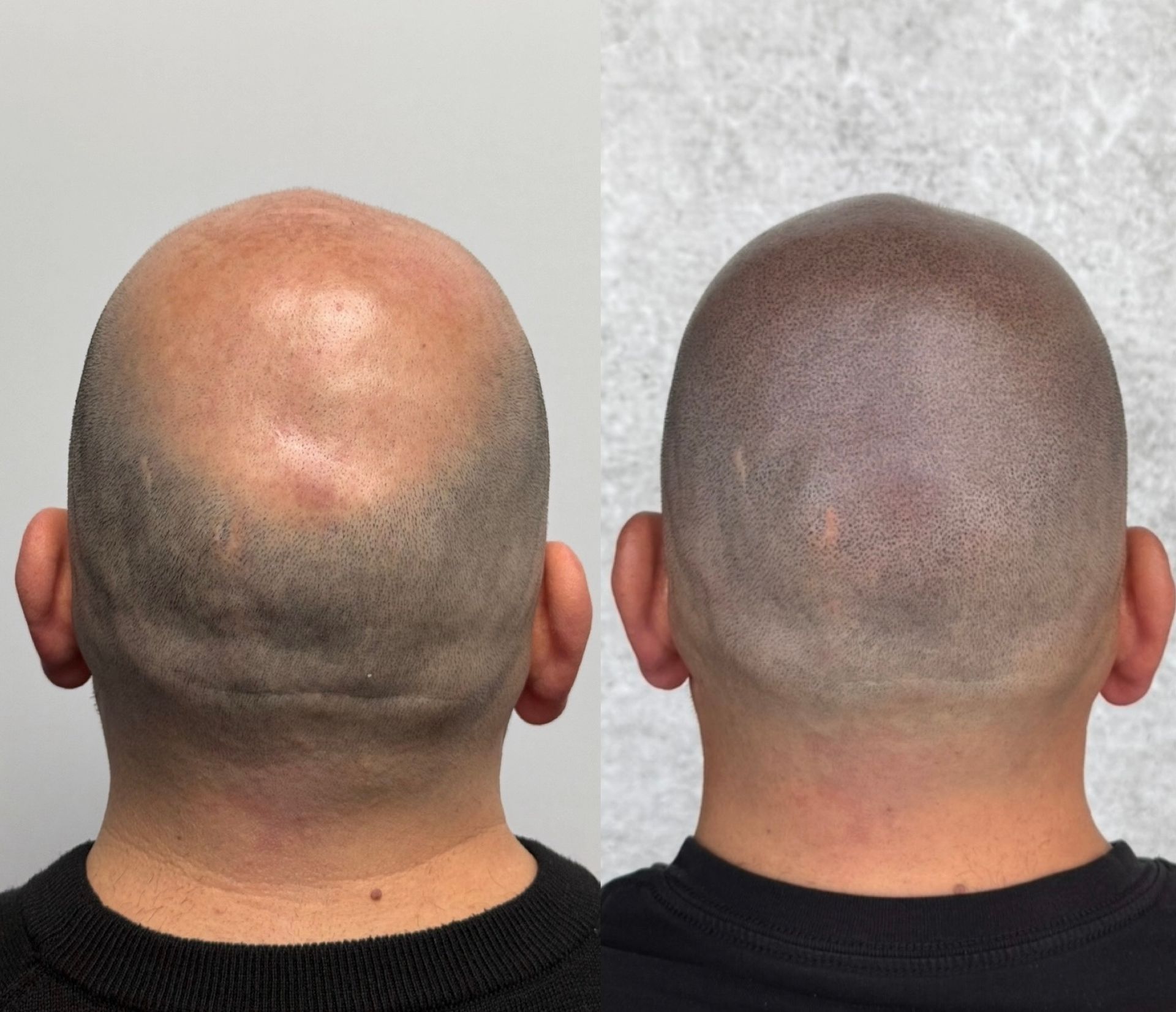 Before and after scalp micropigmentation on a bald head. The after is filled with tiny pigmented dots.