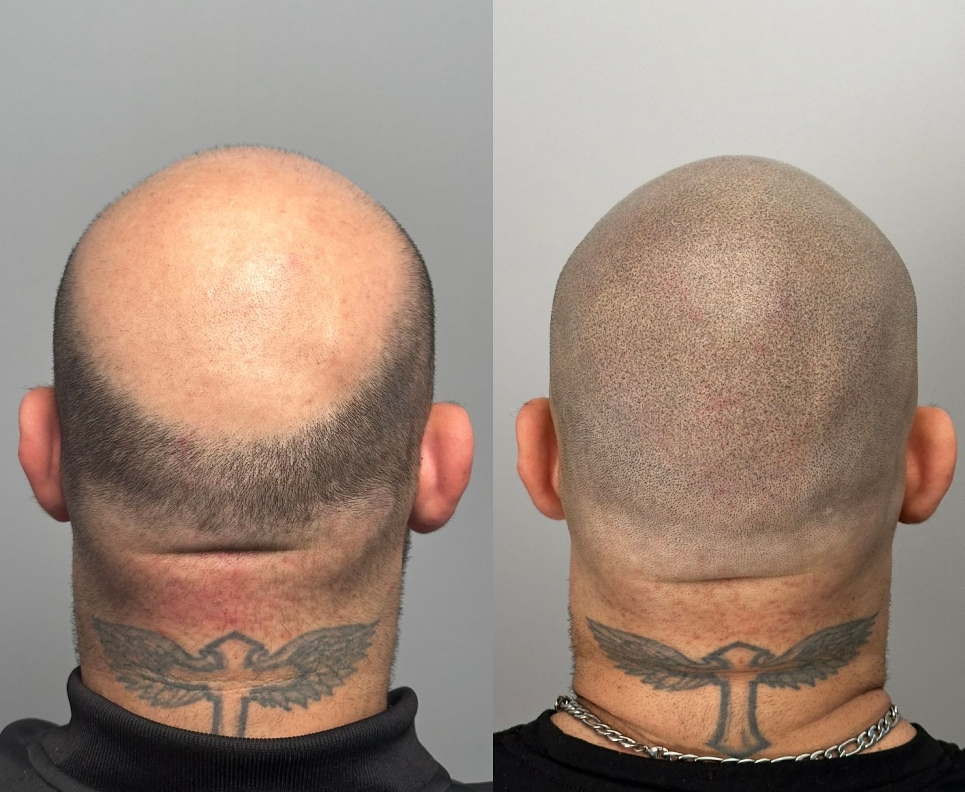 Before and after of a shaved head; scalp micropigmentation creates a fuller appearance.
