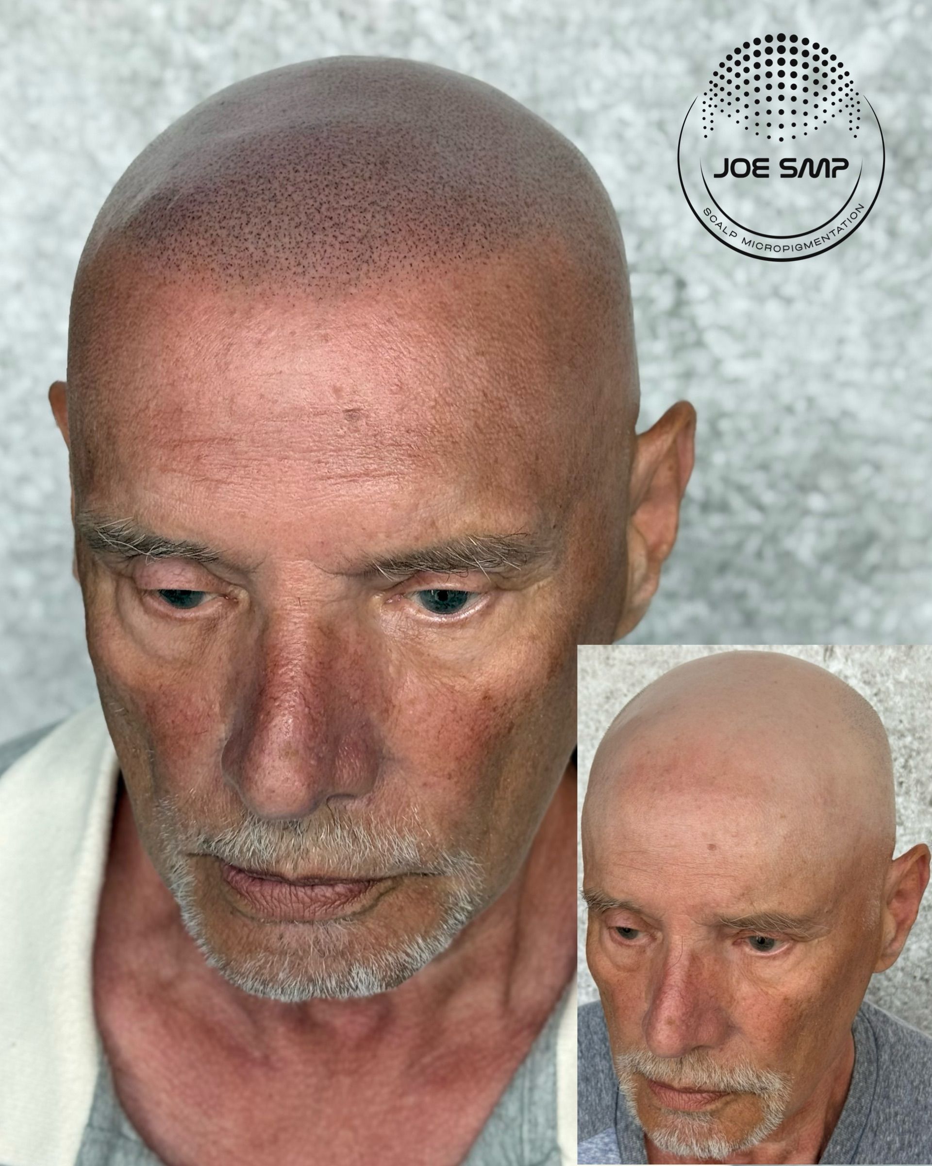 Man with scalp micropigmentation, before and after comparison. The procedure creates a buzz cut appearance.
