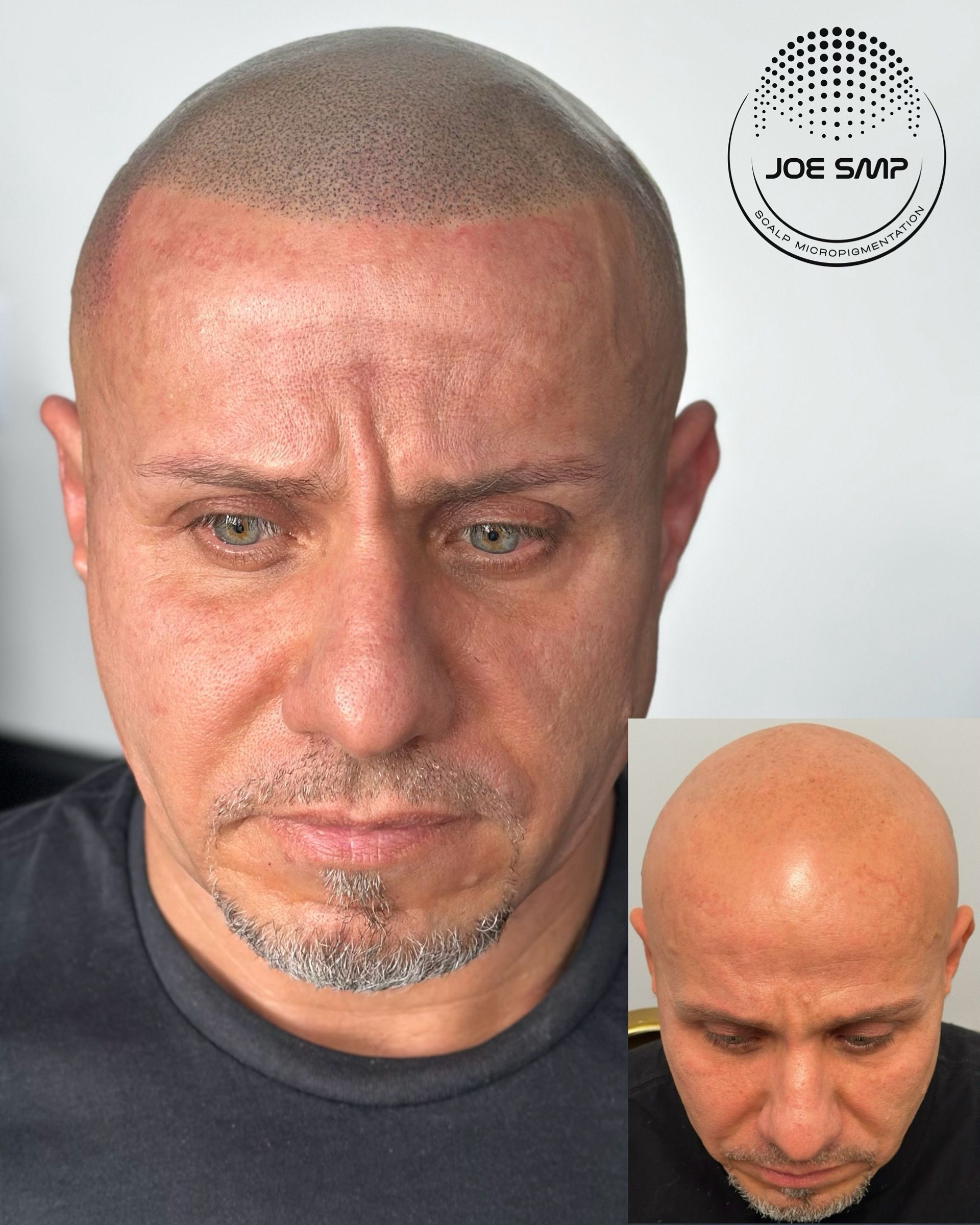 Man with scalp micropigmentation, showcasing before-and-after views.