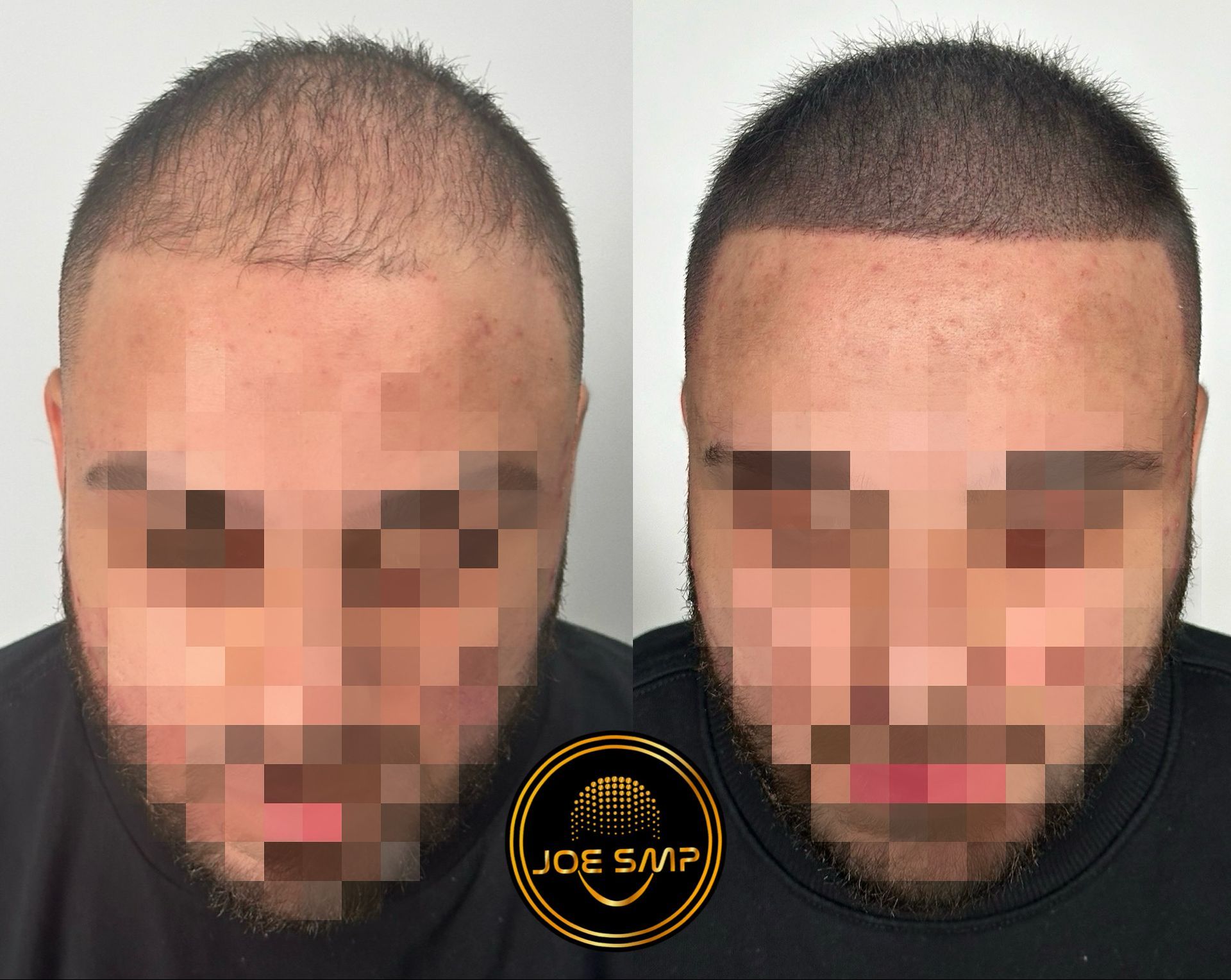 Before and after hair scalp micropigmentation, showcasing a fuller hairline.