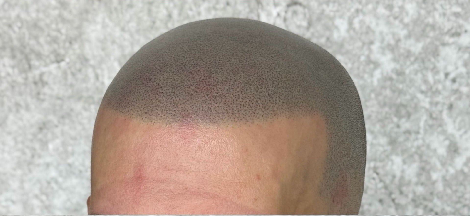 Close-up of a bald head with a hairline of tiny, dark dots, likely scalp micropigmentation.