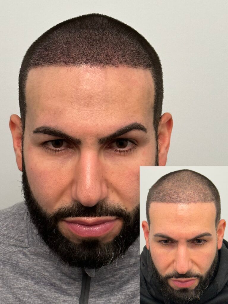 Man with a hairline restoration, two views, dark hair, neutral expression, against a light background.