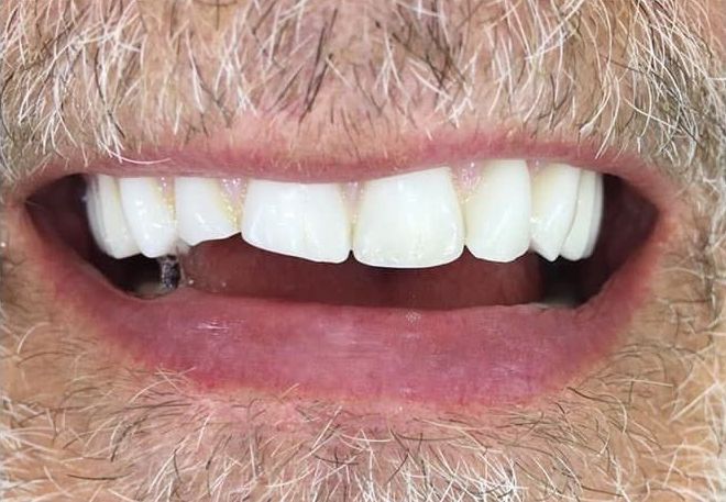 Close-up of a smiling mouth showing white teeth and a slightly open lips.