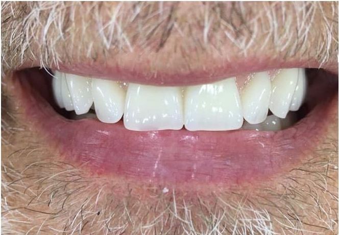 Close-up of a smiling mouth with white teeth and light facial hair around the lips