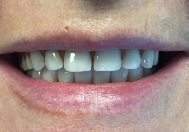Close-up of a smiling mouth showing white teeth and pink lips