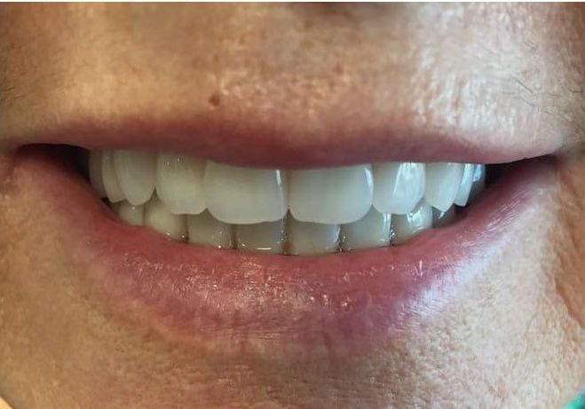 Close-up of a smiling mouth showing white teeth and lips