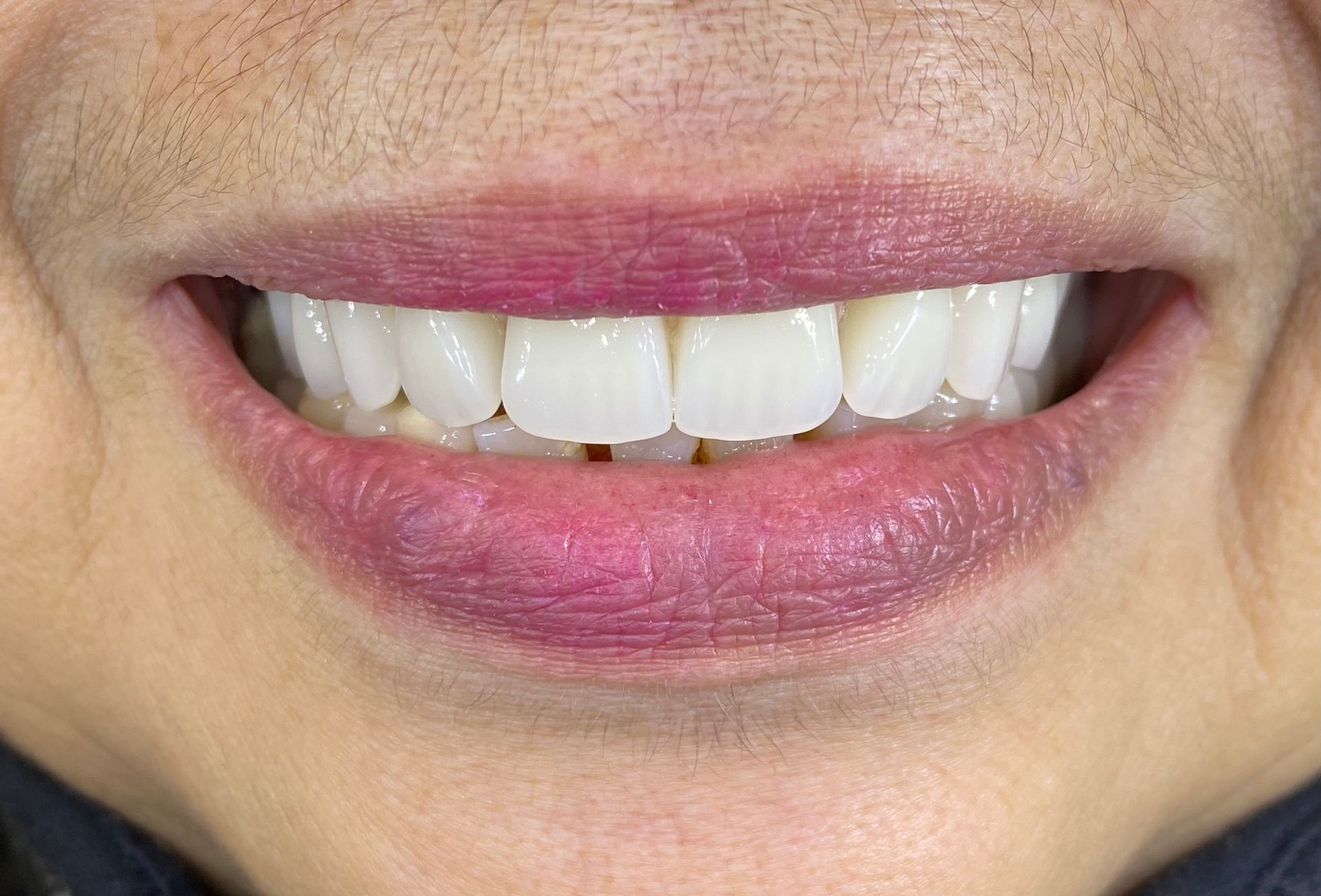 Close-up of a smiling mouth with white teeth and pink lips