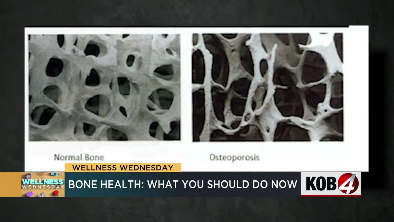 Side-by-side bone scans labeled normal bone and osteoporosis on a news graphic about bone health