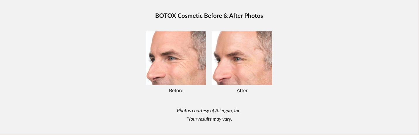 Before and after photos of a man's nose. Before has a bump. After shows a smoother bridge.