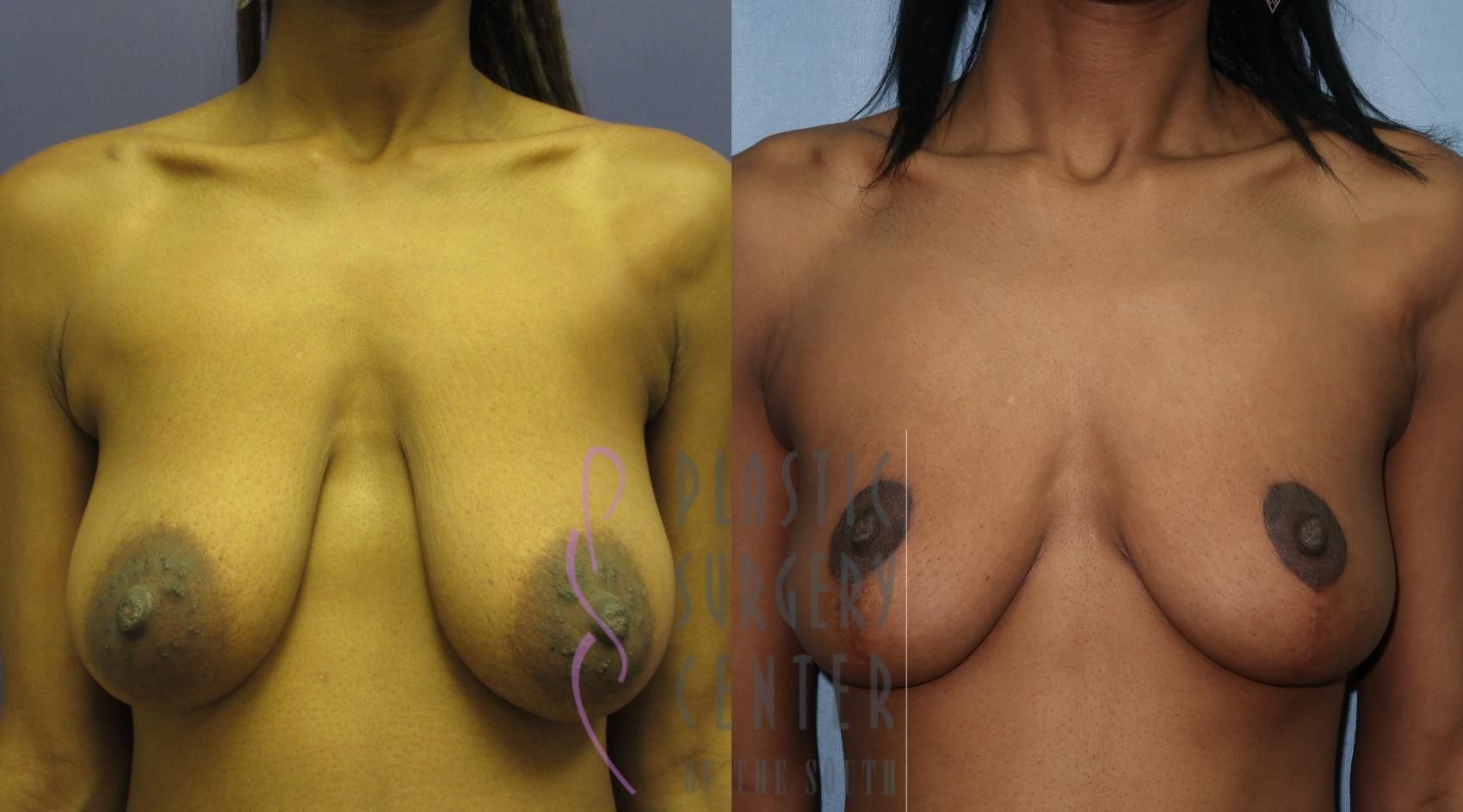 Before and after breast augmentation. Skin tone appears lighter on the left and darker on the right.