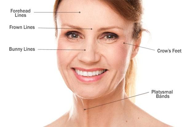 Woman's face with labeled areas of wrinkles: forehead, frown, bunny, crow's feet, and platysmal bands.