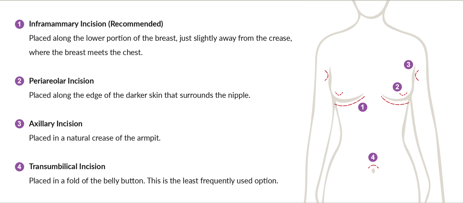 Diagram of a person's torso with numbered incisions: inframammary, periareolar, axillary, and transumbilical.