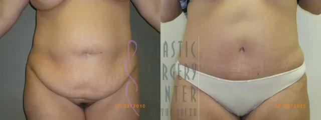 Before and after tummy tuck result