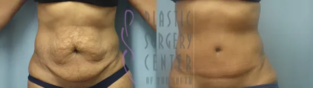 Before and after tummy tuck result